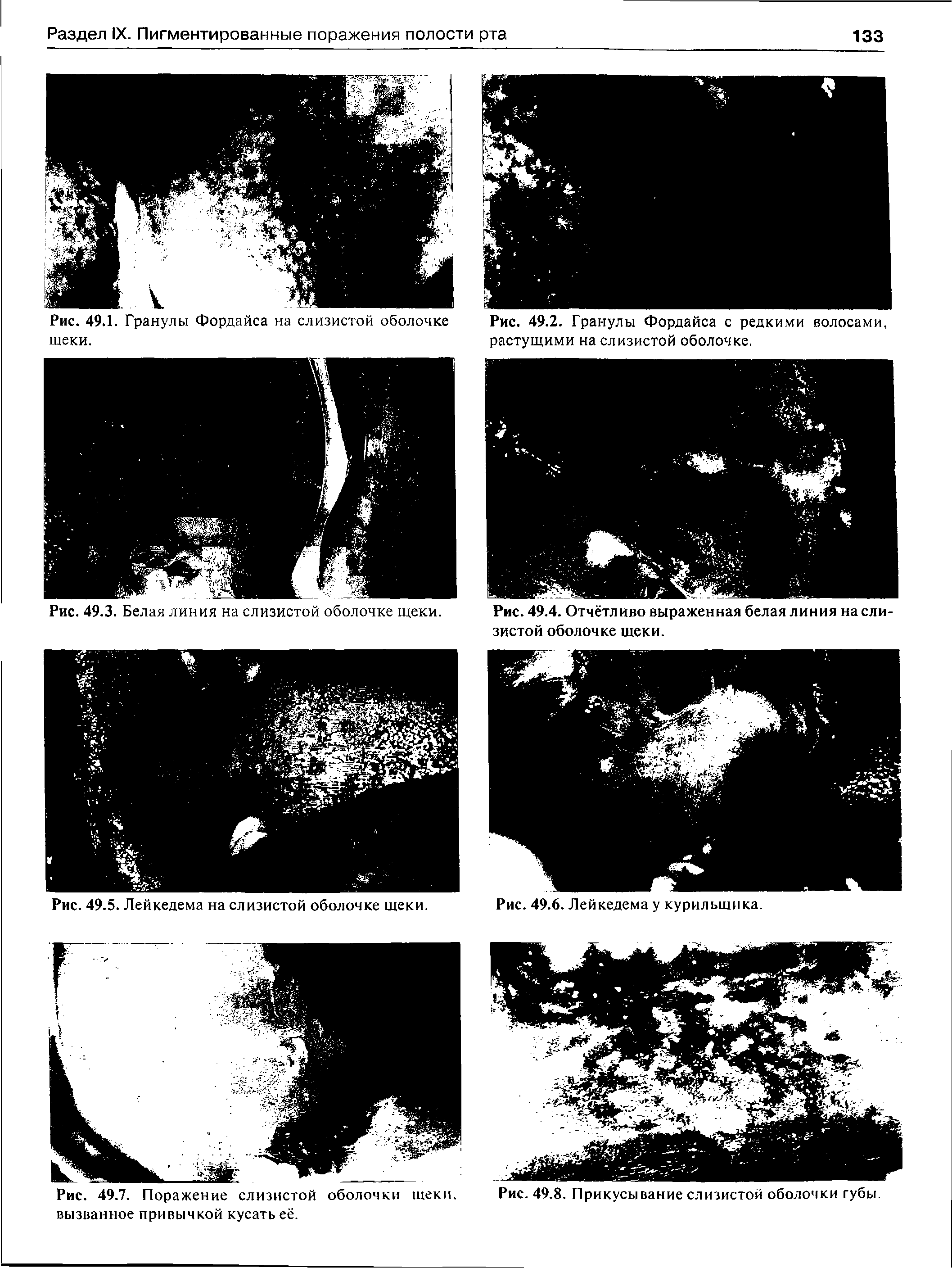 Рис. 49.5. Лейкедема на слизистой оболочке щеки. Рис. 49.6. Лейкедема у курильщика.