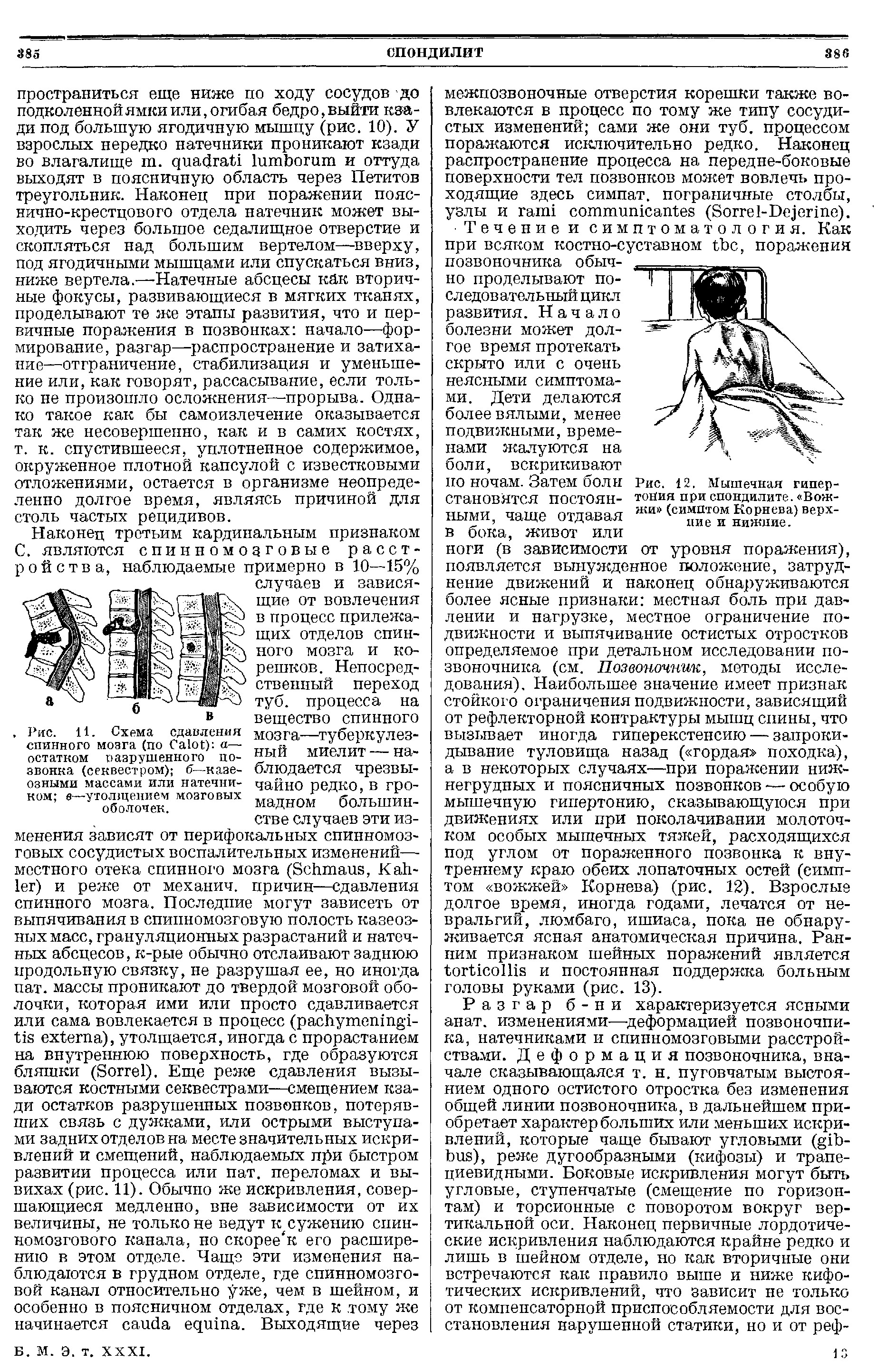 Рис. 11. Схема сдавления спинного мозга (по C ) а— остатком разрушенного позвонка (секвестром) б— казеозными массами или натечни-ком в—утолщением мозговых оболочек.