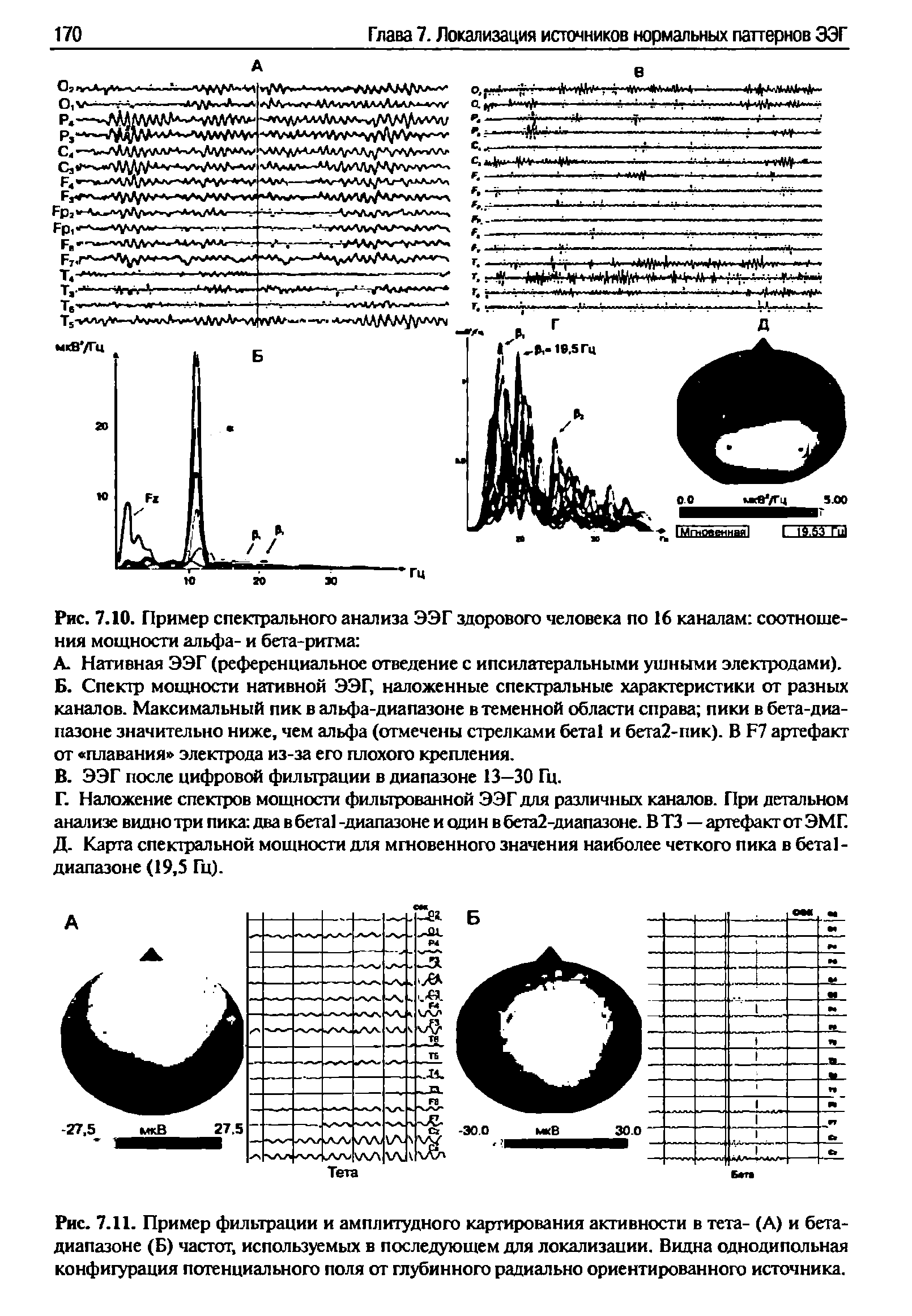 Рис. 7.11. Пример фильтрации и амплитудного картирования активности в тета- (А) и бета-диапазоне (Б) частот, используемых в последующем для локализации. Видна однодипольная конфигурация потенциального поля от глубинного радиально ориентированного источника.