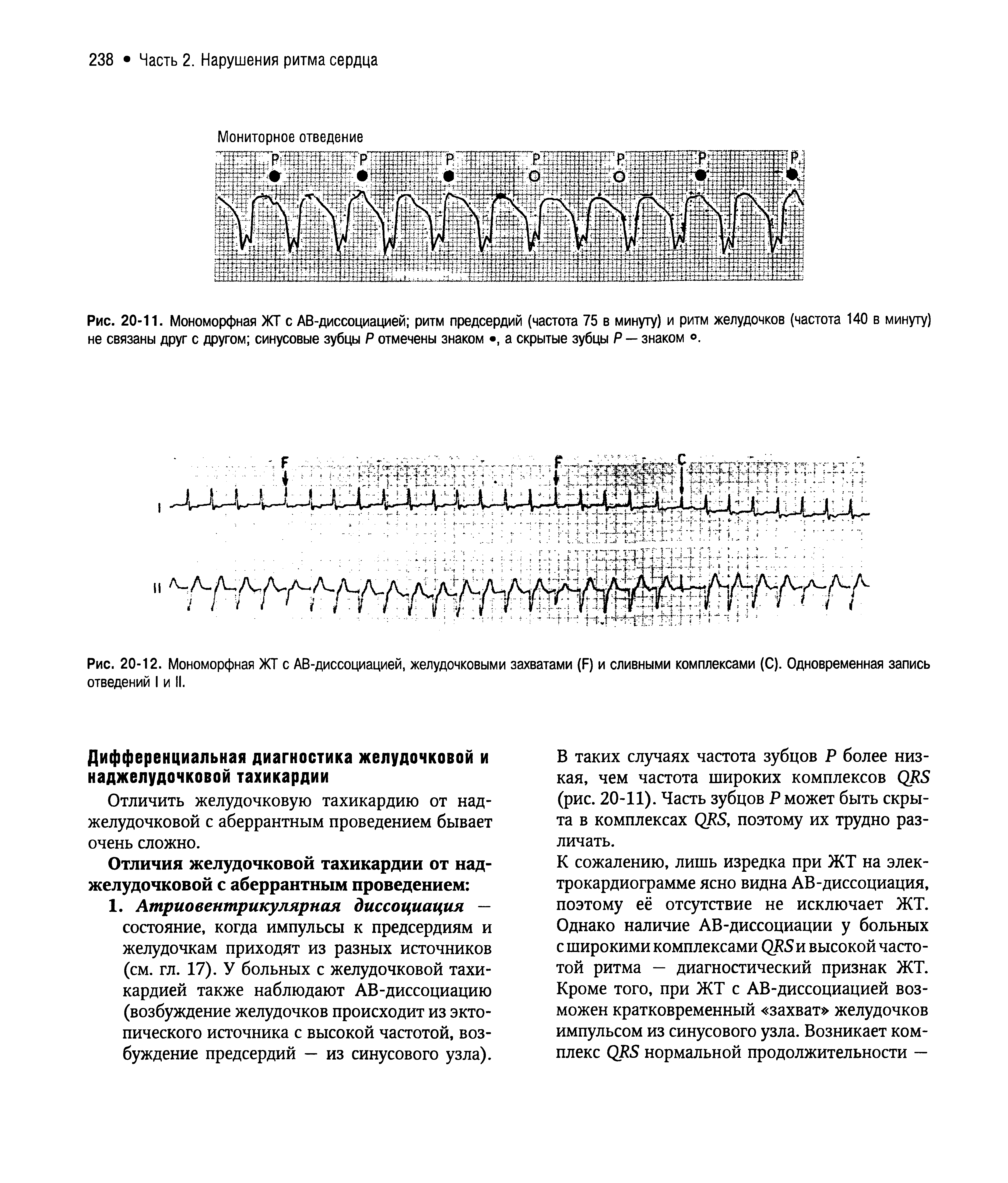 Рис. 20-12. Мономорфная ЖТ с АВ-диссоциацией, желудочковыми захватами (Б) и сливными комплексами (С). Одновременная запись отведений I и II.