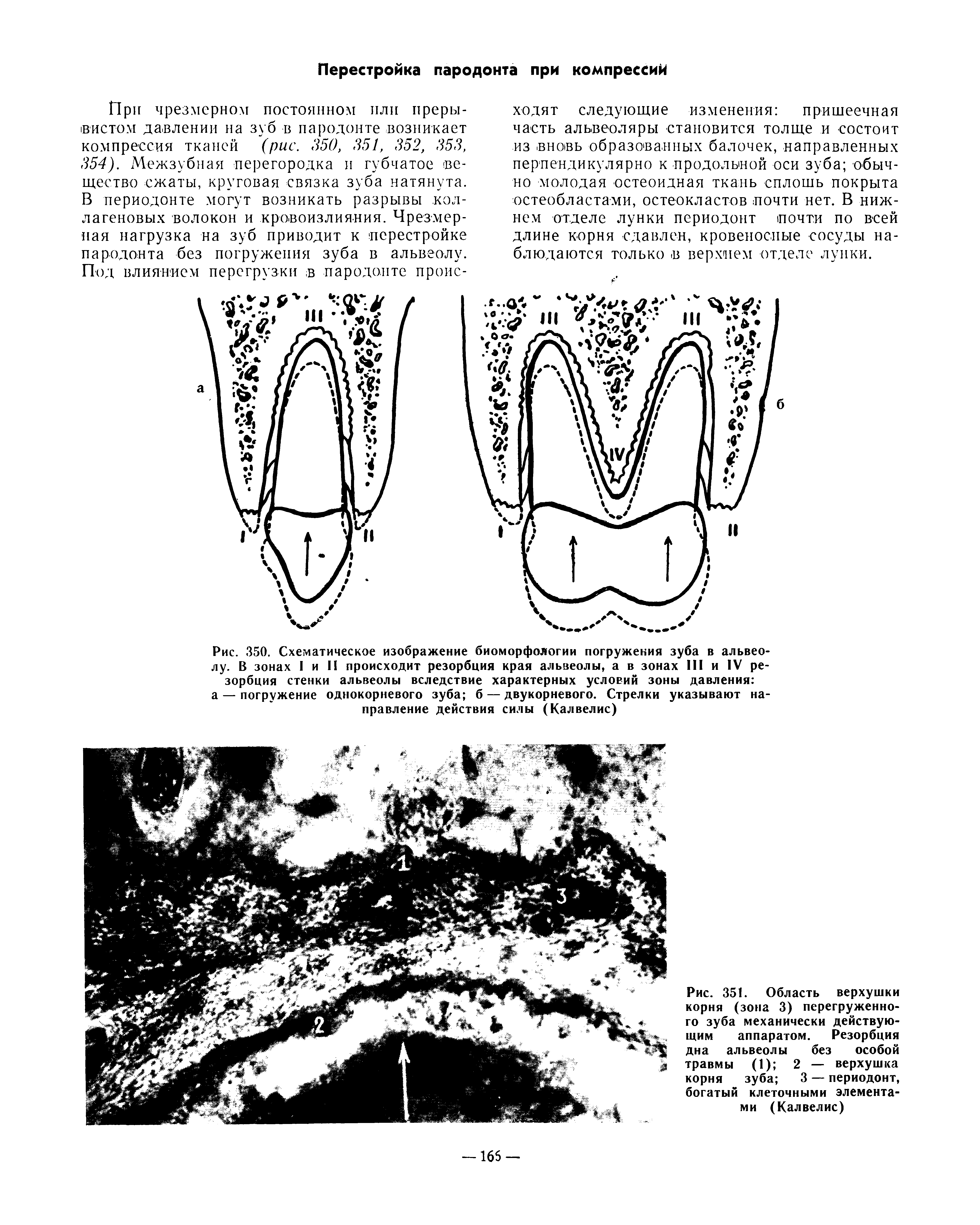 Рис. 351. Область верхушки корня (зона 3) перегруженного зуба механически действующим аппаратом. Резорбция дна альвеолы без особой травмы (1) 2 — верхушка...