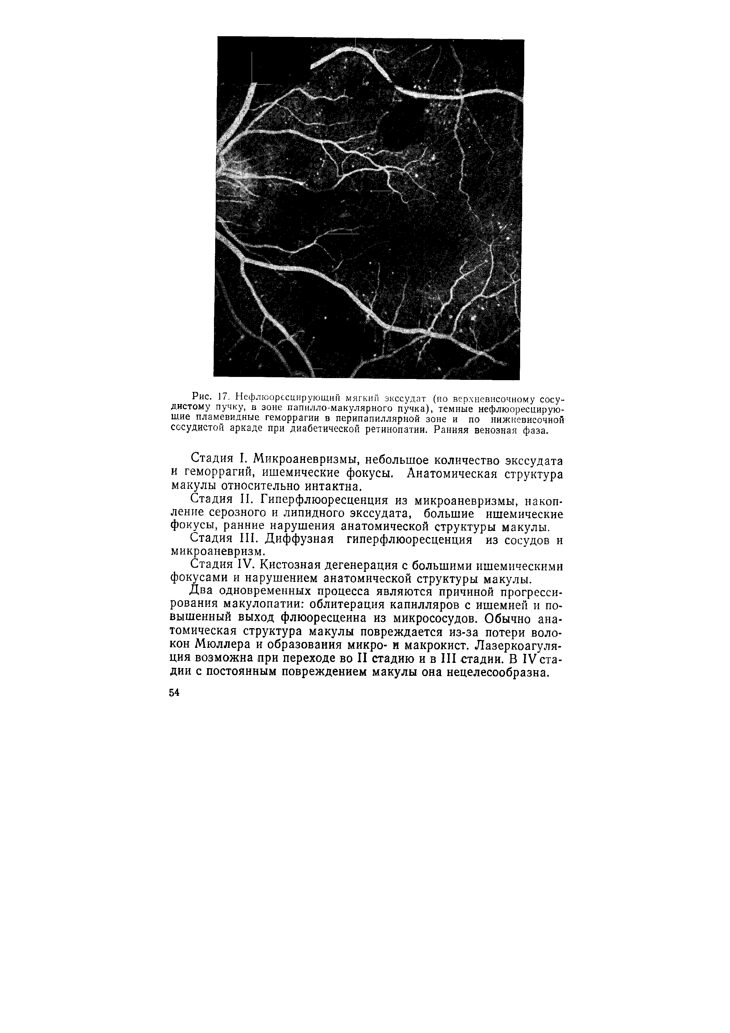 Рис. 17. Нефлюоресцирующий мягкий экссудат (ио верхневисочному сосудистому пучку, в зоне папилло-макулярного пучка), темные нефлюоресцирую-шие пламевидные геморрагии в перипапиллярной зоне и по нижневисочной сосудистой аркаде при диабетической ретинопатии. Ранняя венозная фаза.