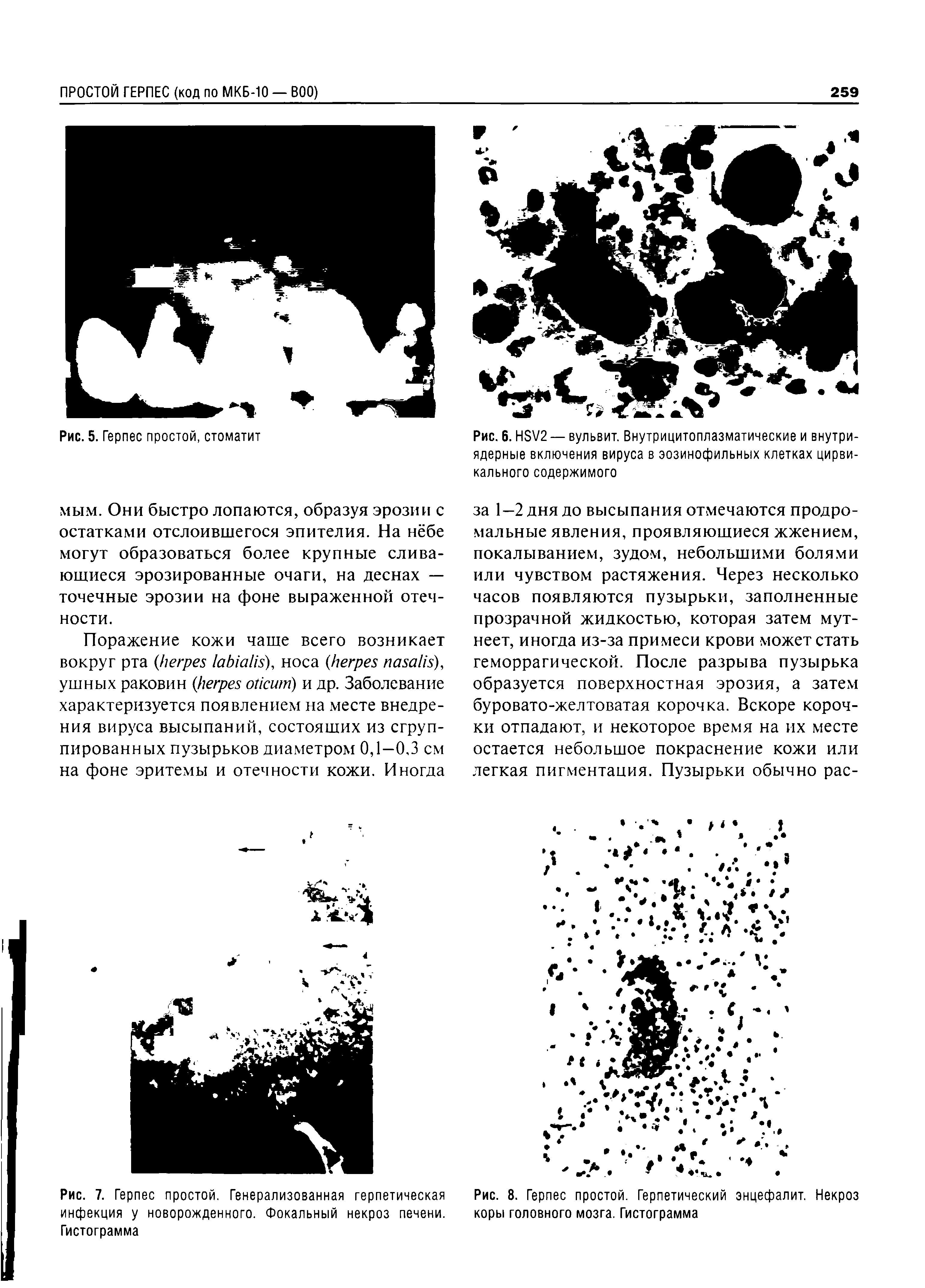 Рис. 7. Герпес простой. Генерализованная герпетическая инфекция у новорожденного. Фокальный некроз печени. Гистограмма...