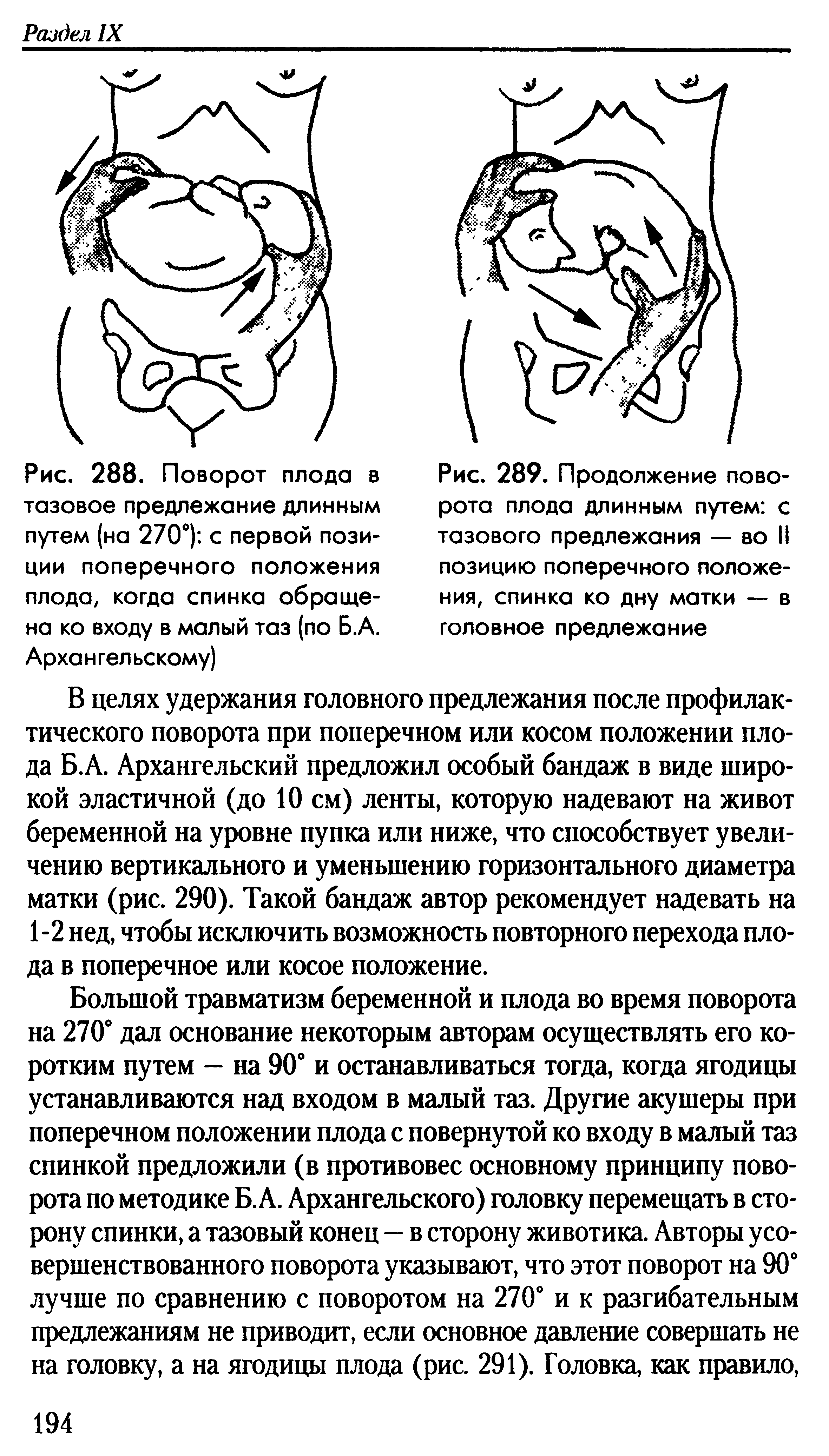 Рис. 289. Продолжение поворота плода длинным путем с тазового предлежания — во II позицию поперечного положения, спинка ко дну матки — в головное предлежание...