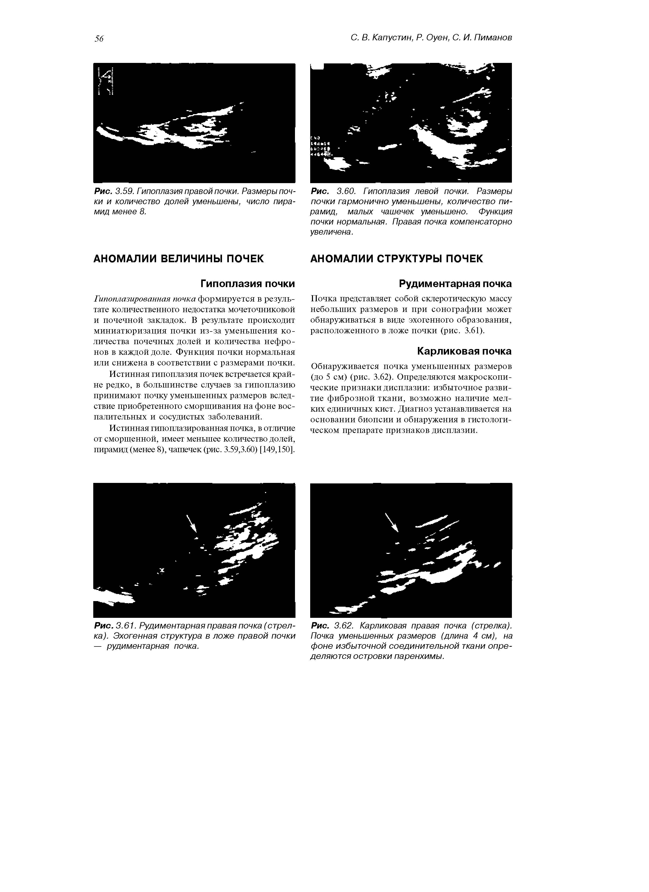 Рис. 3.61. Рудиментарная правая почка (стрелка). Эхогенная структура в ложе правой почки — рудиментарная почка.