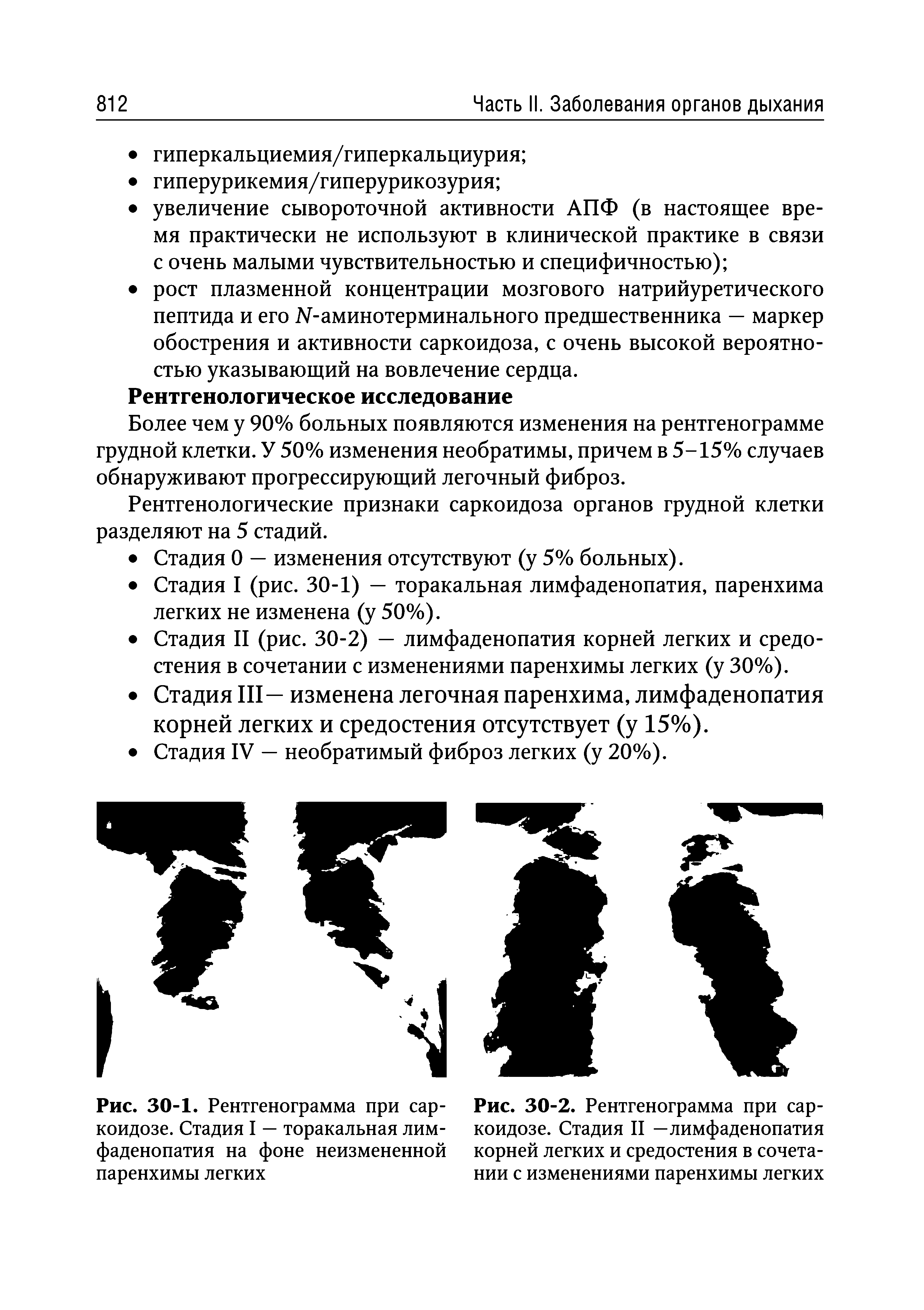 Рис. 30-2. Рентгенограмма при саркоидозе. Стадия II —лимфаденопатия корней легких и средостения в сочетании с изменениями паренхимы легких...