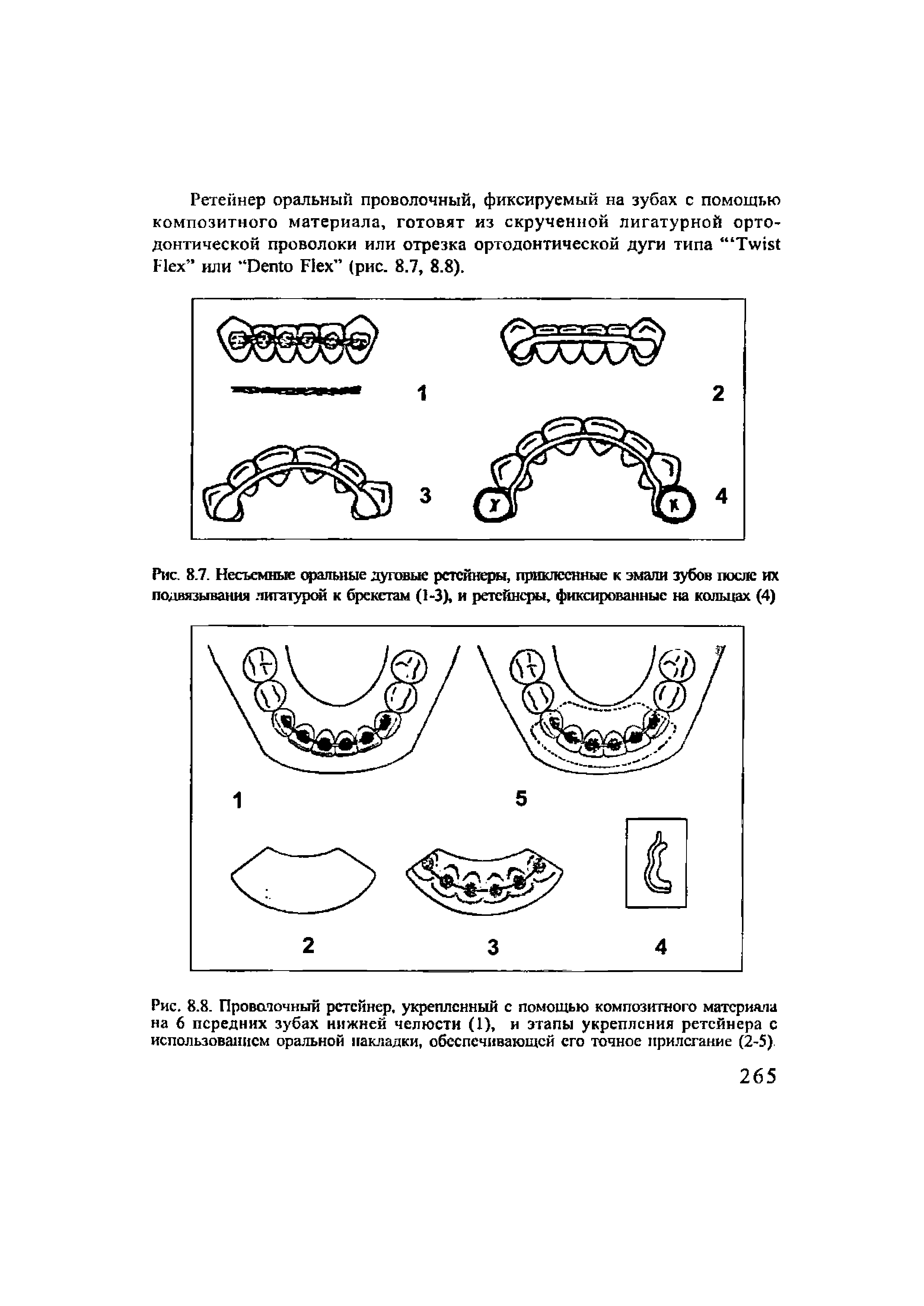 Рис. 8.8. Проволочный ретейнер, укрепленный с помощью композитного материала на 6 передних зубах нижней челюсти (1), н этапы укрепления ретейнера с использованием оральной накладки, обеспечивающей его точное прилегание (2-5)...