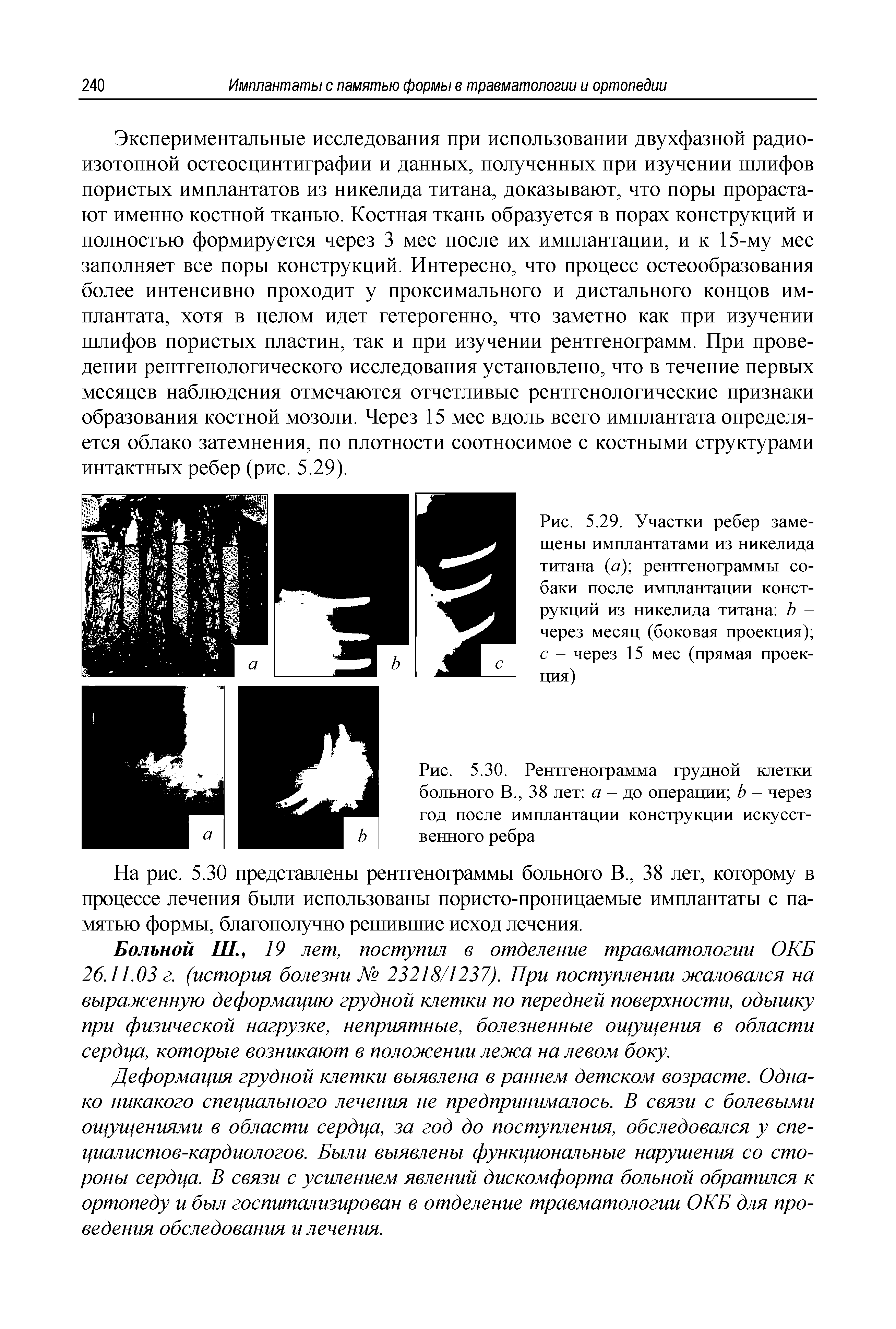 Рис. 5.29. Участки ребер замещены имплантатами из никелида титана (а) рентгенограммы собаки после имплантации конструкций из никелида титана Ь — через месяц (боковая проекция) с - через 15 мес (прямая проекция)...