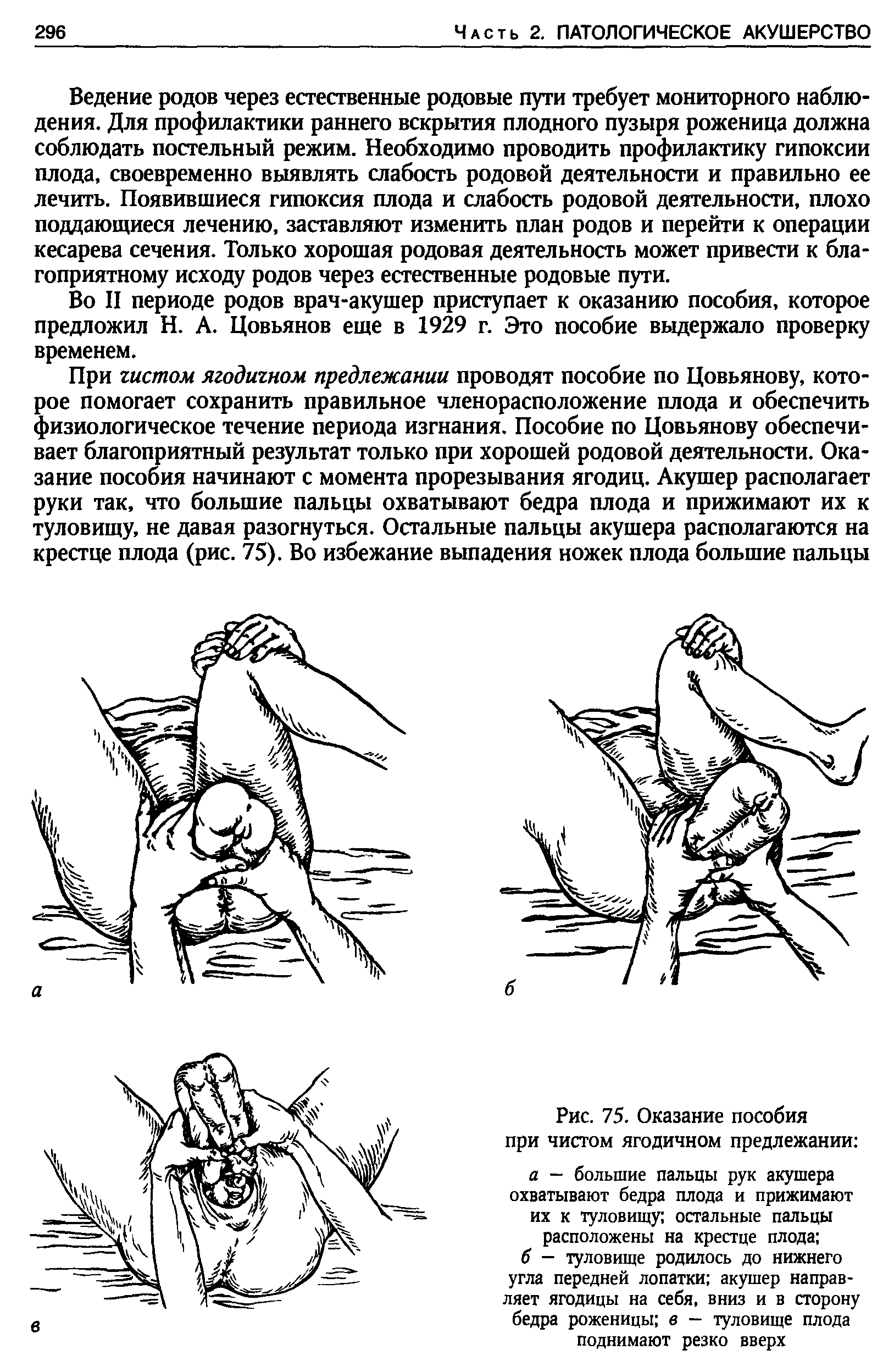 Рис. 75. Оказание пособия при чистом ягодичном предлежании а — большие пальцы рук акушера охватывают бедра плода и прижимают их к туловищу остальные пальцы расположены на крестце плода ...