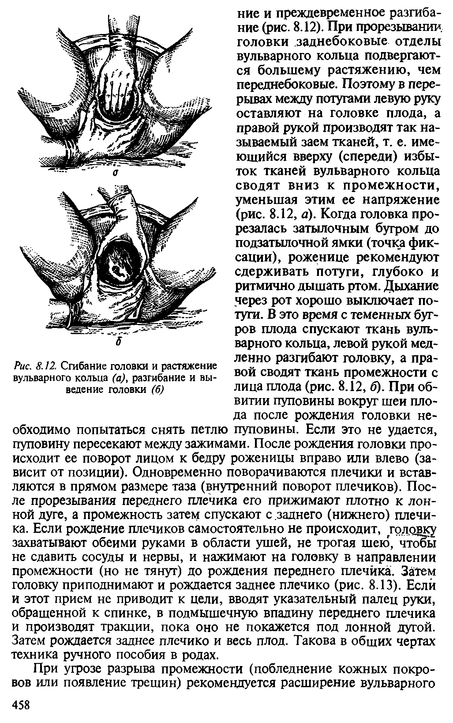 Рис. 8.12. Сгибание головки и растяжение вульварного кольца (а), разгибание и выведение головки (6)...