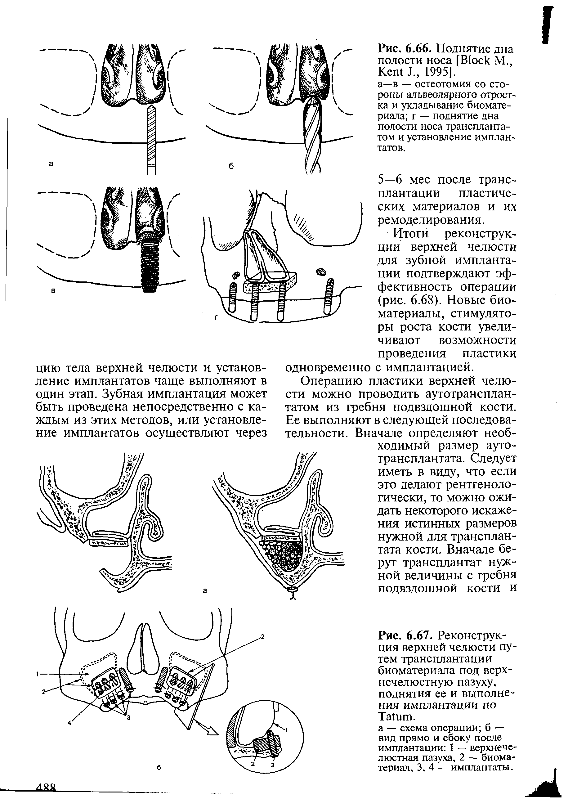 Рис. 6.67. Реконструкция верхней челюсти путем трансплантации биоматериала под верхнечелюстную пазуху, поднятия ее и выполнения имплантации по T .