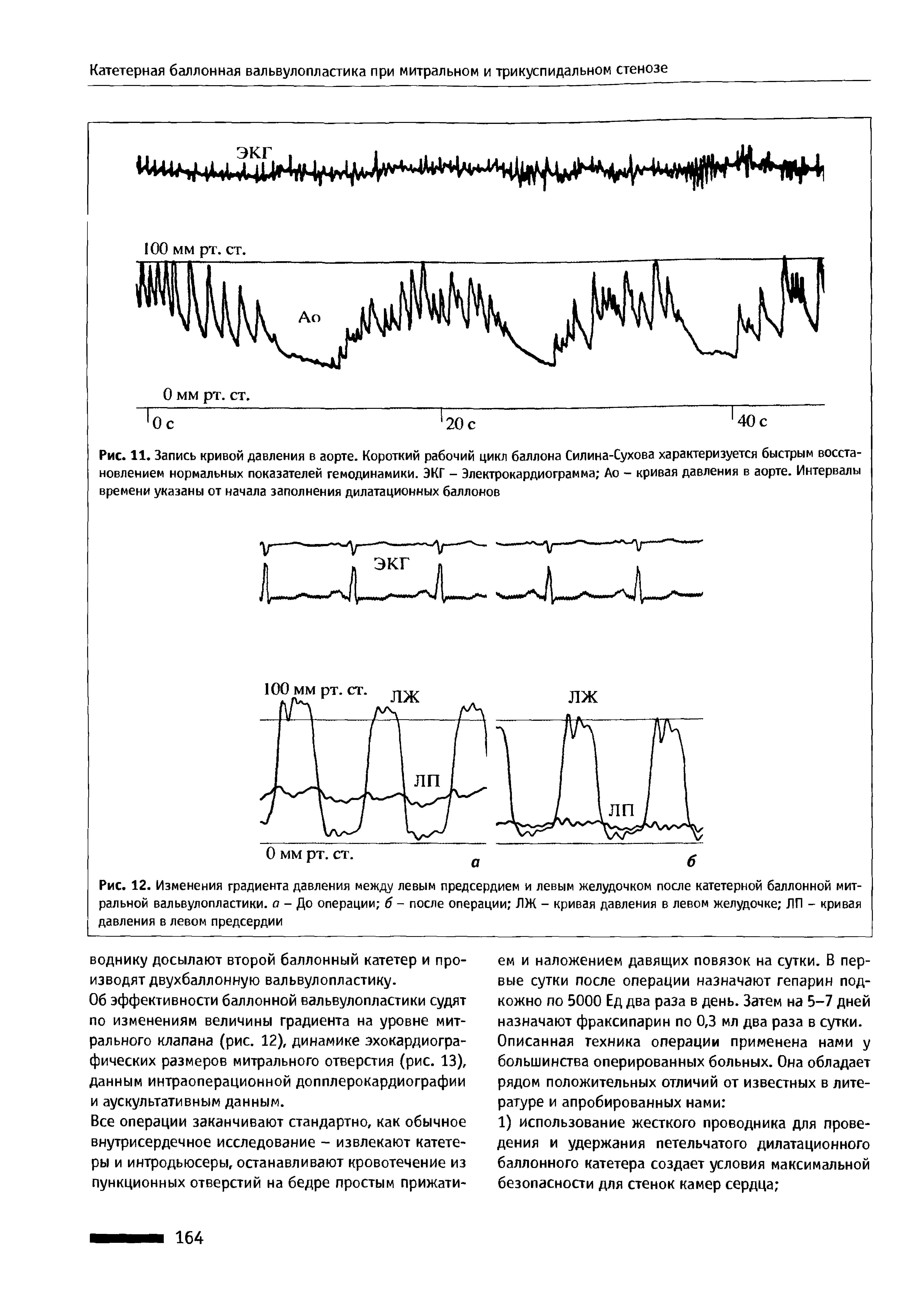 Рис. 11. Запись кривой давления в аорте. Короткий рабочий цикл баллона Силина-Сухова характеризуется быстрым восстановлением нормальных показателей гемодинамики. ЭКГ - Электрокардиограмма Ао - кривая давления в аорте. Интервалы времени указаны от начала заполнения дилатационных баллонов...