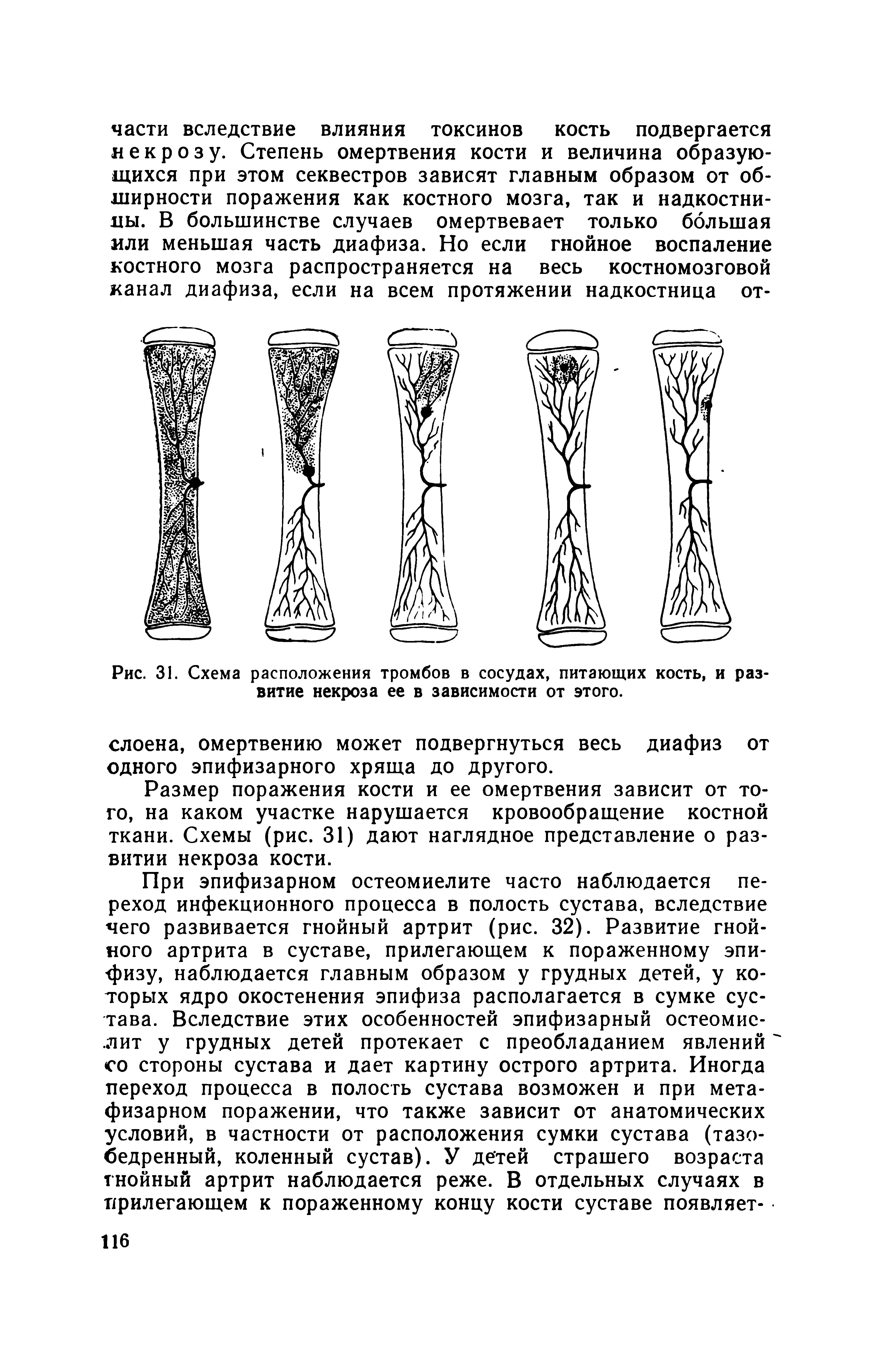 Рис. 31. Схема расположения тромбов в сосудах, питающих кость, и развитие некроза ее в зависимости от этого.