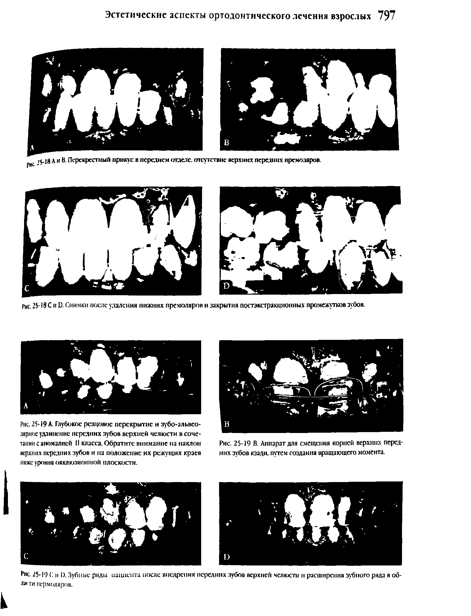 Рис. 25-18 С и й Снимки после удаления нижних премоляров и закрытия постэкстракционных промежутков зубов.