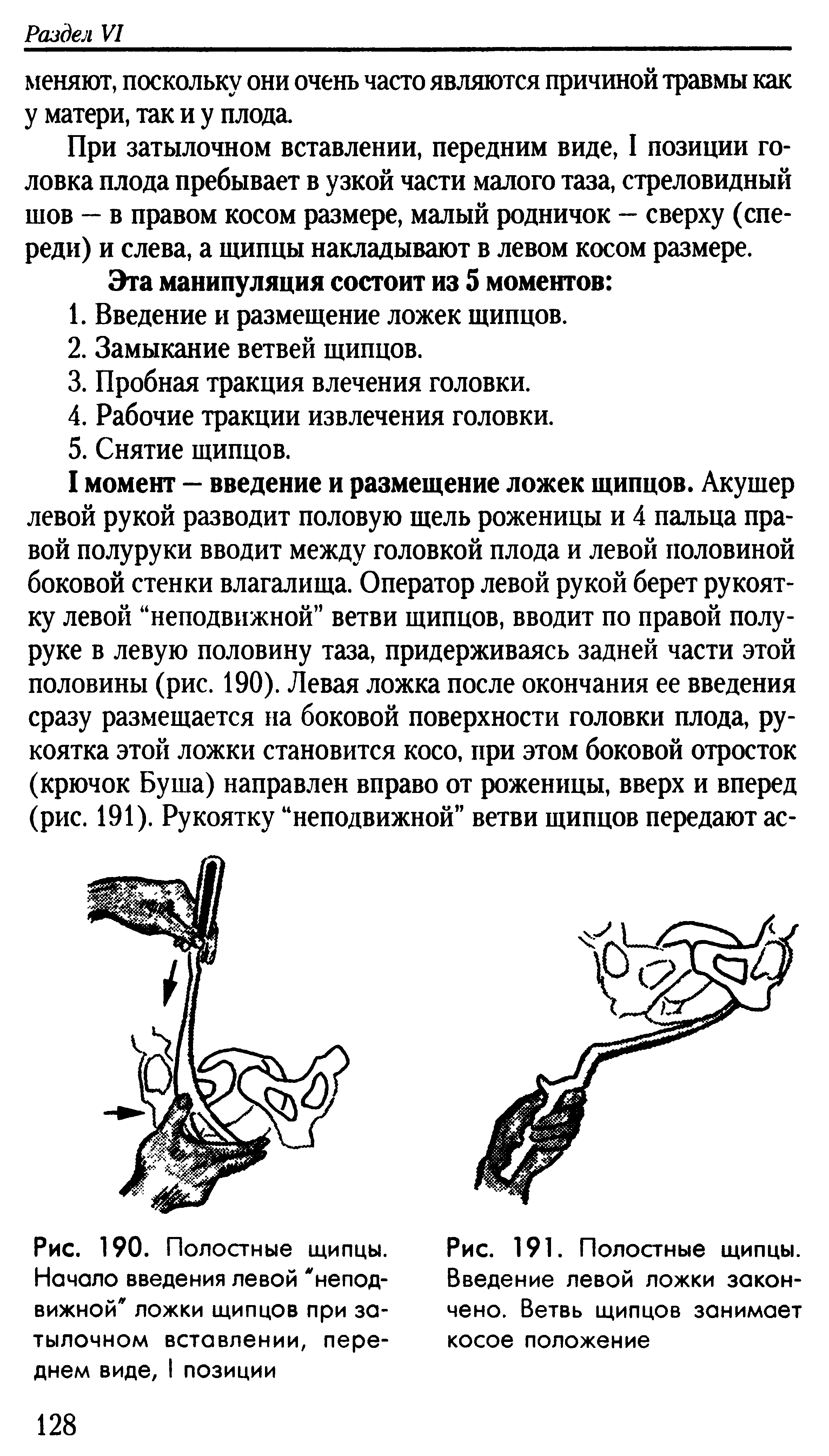 Рис. 191. Полостные щипцы. Введение левой ложки закончено. Ветвь щипцов занимает косое положение...