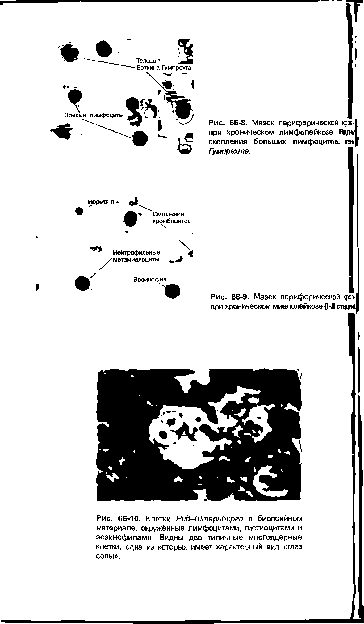 Рис. 66-10. Клетки Рид-Штернберга в биопсийном материале, окружённые лимфоцитами, гистиоцитами и эозинофилами Видны две типичные многоядерные клетки, одна из которых имеет характерный вид глаз совы .