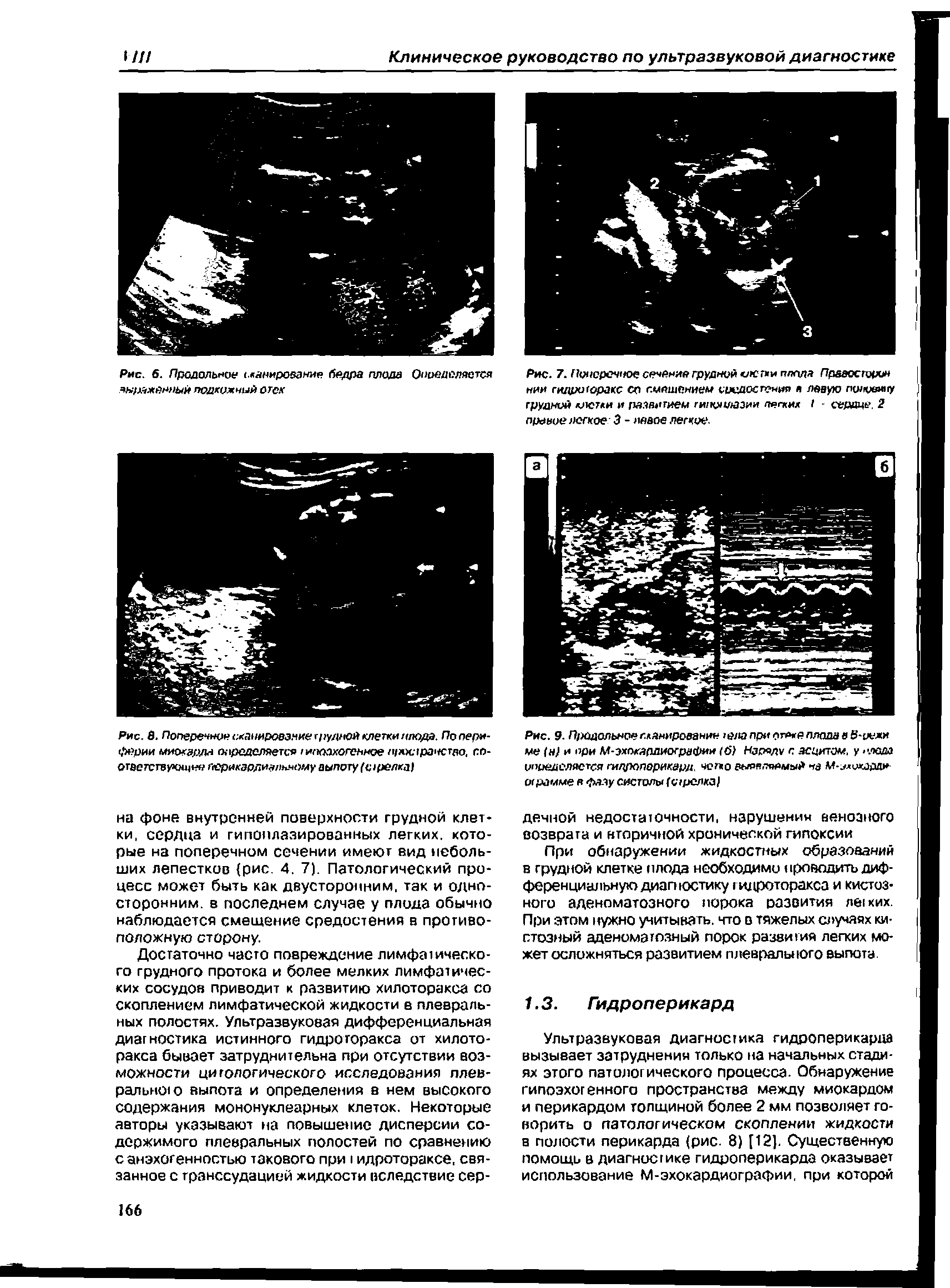 Рис. 7. Поперечное сечения грудной клс пи плода Прааосторон нии гидро(оракс со смешением средостения я левую поирвииу грудной клетки и развитием гипоплазии пеших I - сердце. 2 правое легкое 3 - левое легкое.