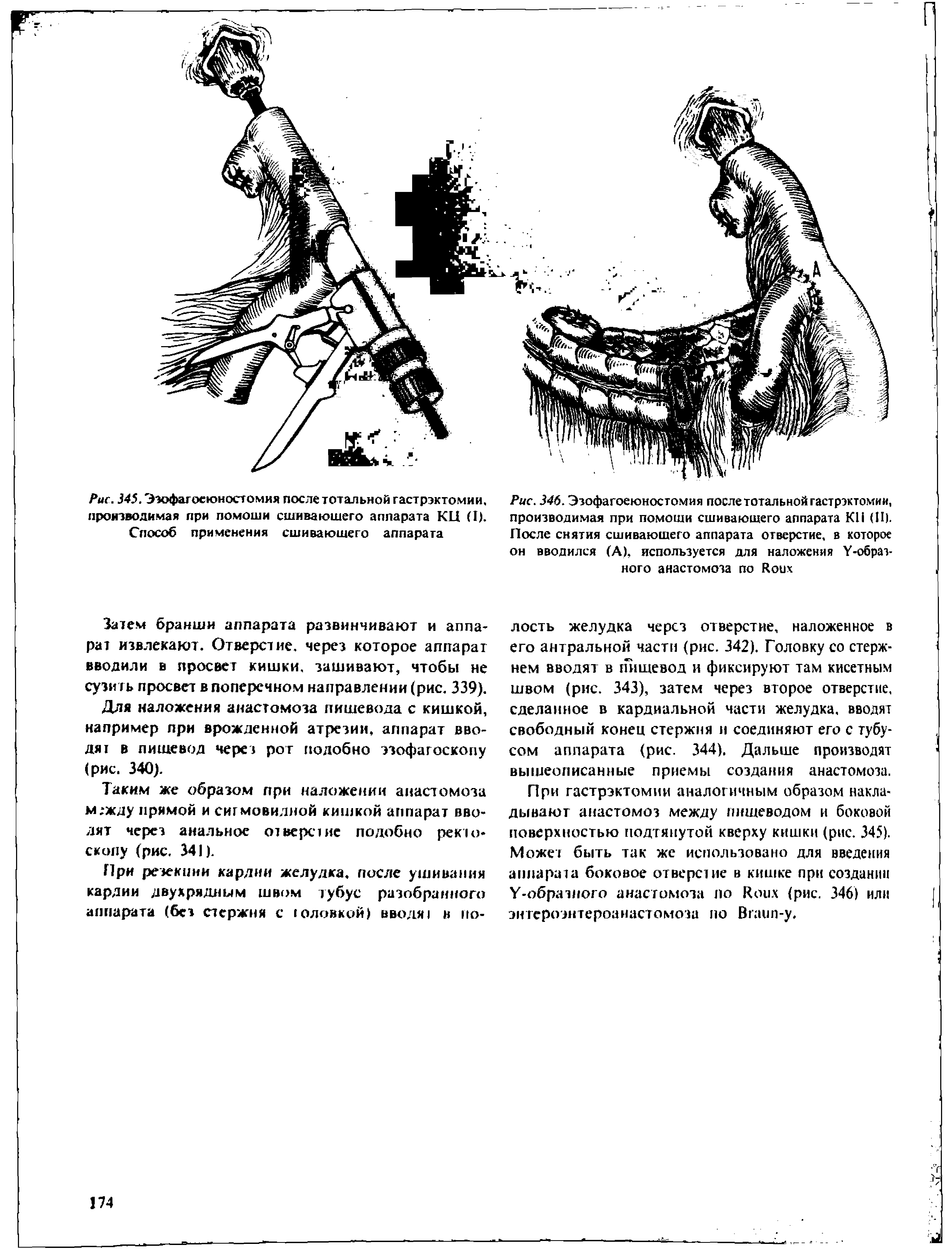 Рис. 346. Эзофагоеюностомия после тотальной гастрэктомии, производимая при помощи сшивающего аппарата КН (И). После снятия сшивающего аппарата отверстие, в которое он вводился (А), используется для наложения Y-обратного анастомоза по R ...