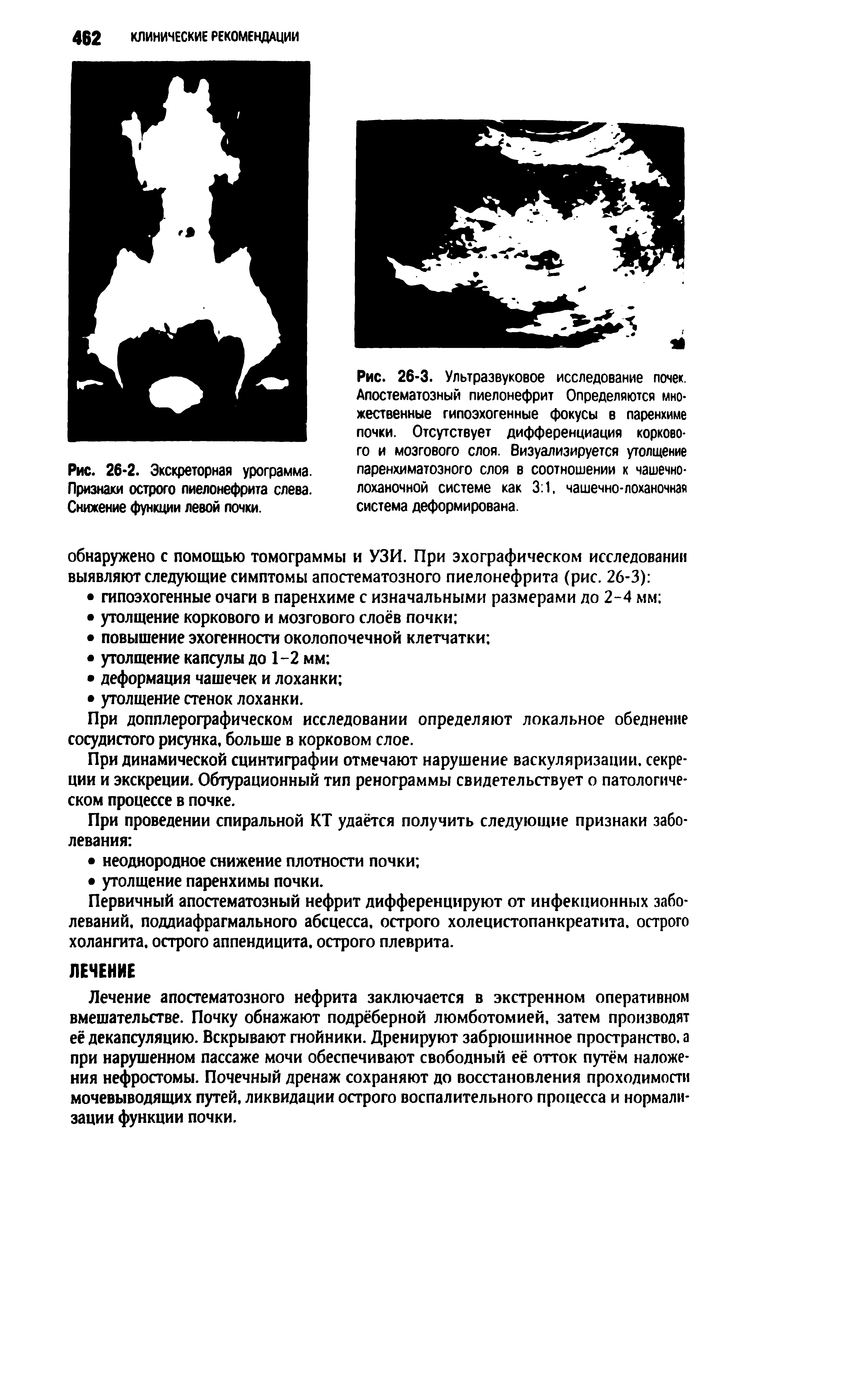 Рис. 26-3. Ультразвуковое исследование почек. Апостематозный пиелонефрит Определяются множественные гипоэхогенные фокусы в паренхиме почки. Отсутствует дифференциация корково-...