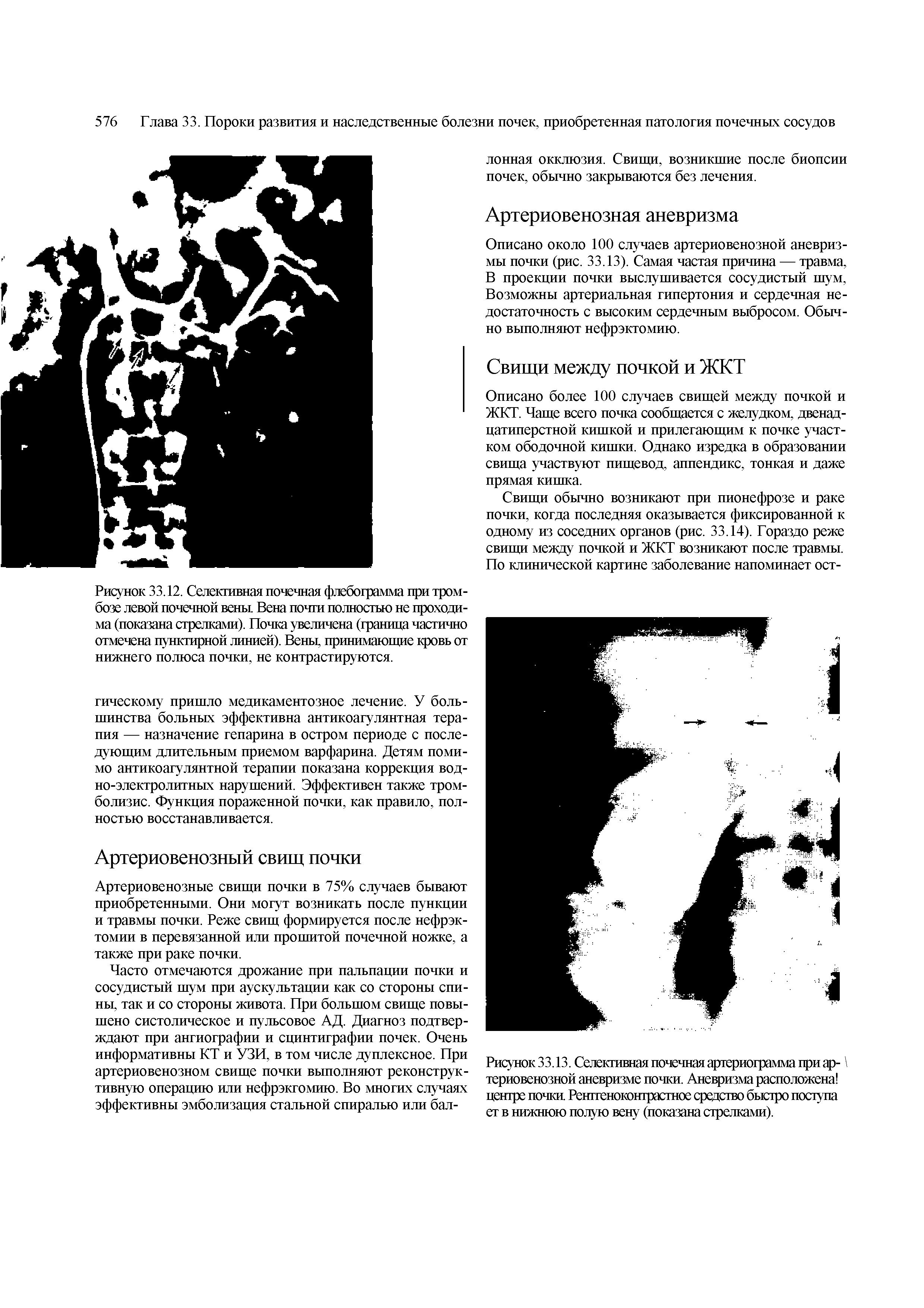 Рисунок33.13. Селективная почечная артериограмма при ар- териовенозной аневризме почки. Аневризма расположена центре почки. Рентгеноконтрастное средство быстро посгупа ет в нижнюю полую вену (показана стрелками).