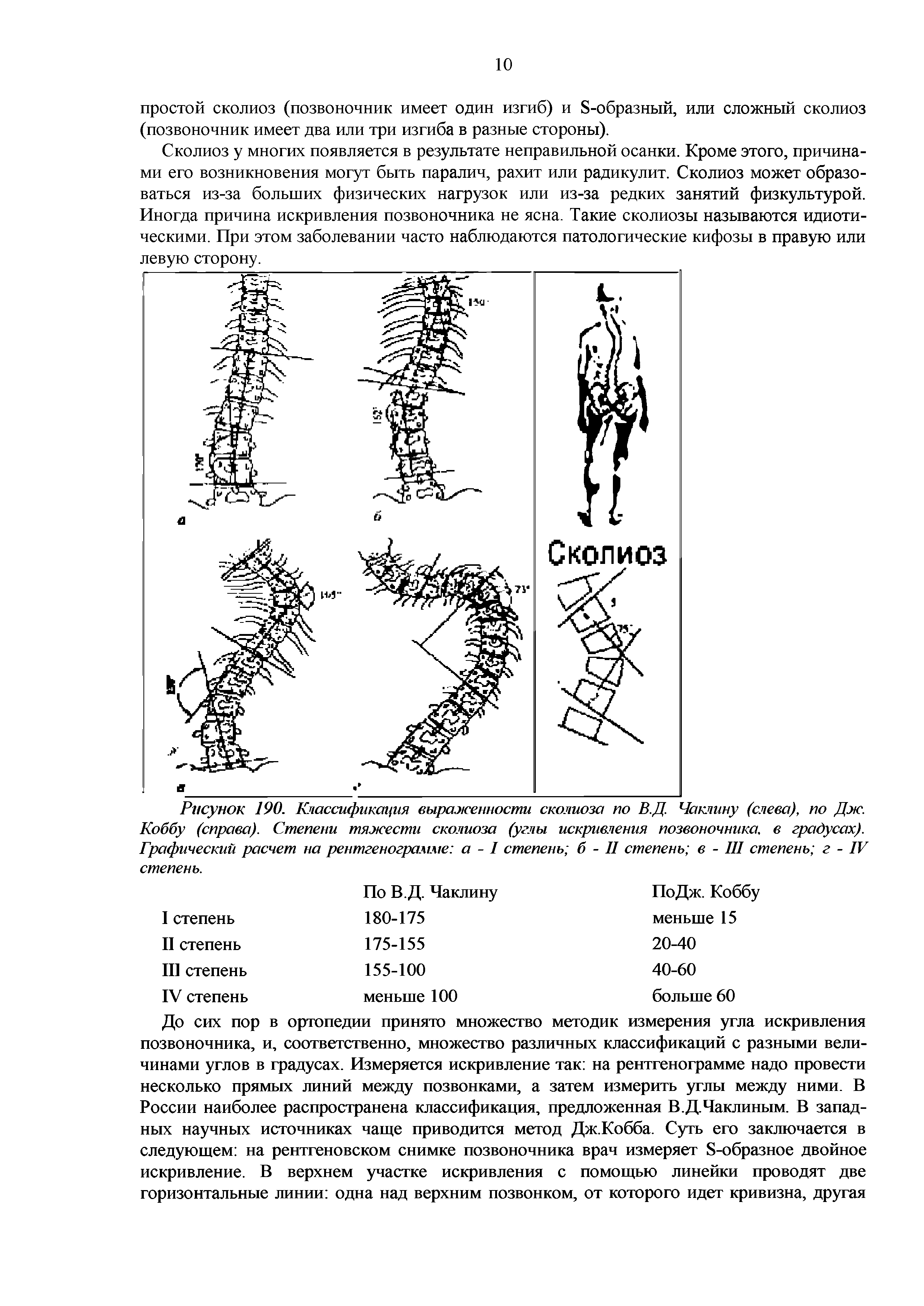 Рисунок 190. Классификация выраженности сколиоза по В.Д. Чаклину (слева), по Дж. Коббу (справа). Степени тяжести сколиоза (углы искривления позвоночника, в градусах). Графический расчет на рентгенограмме а - I степень б - II степень в - III степень г - IV степень.
