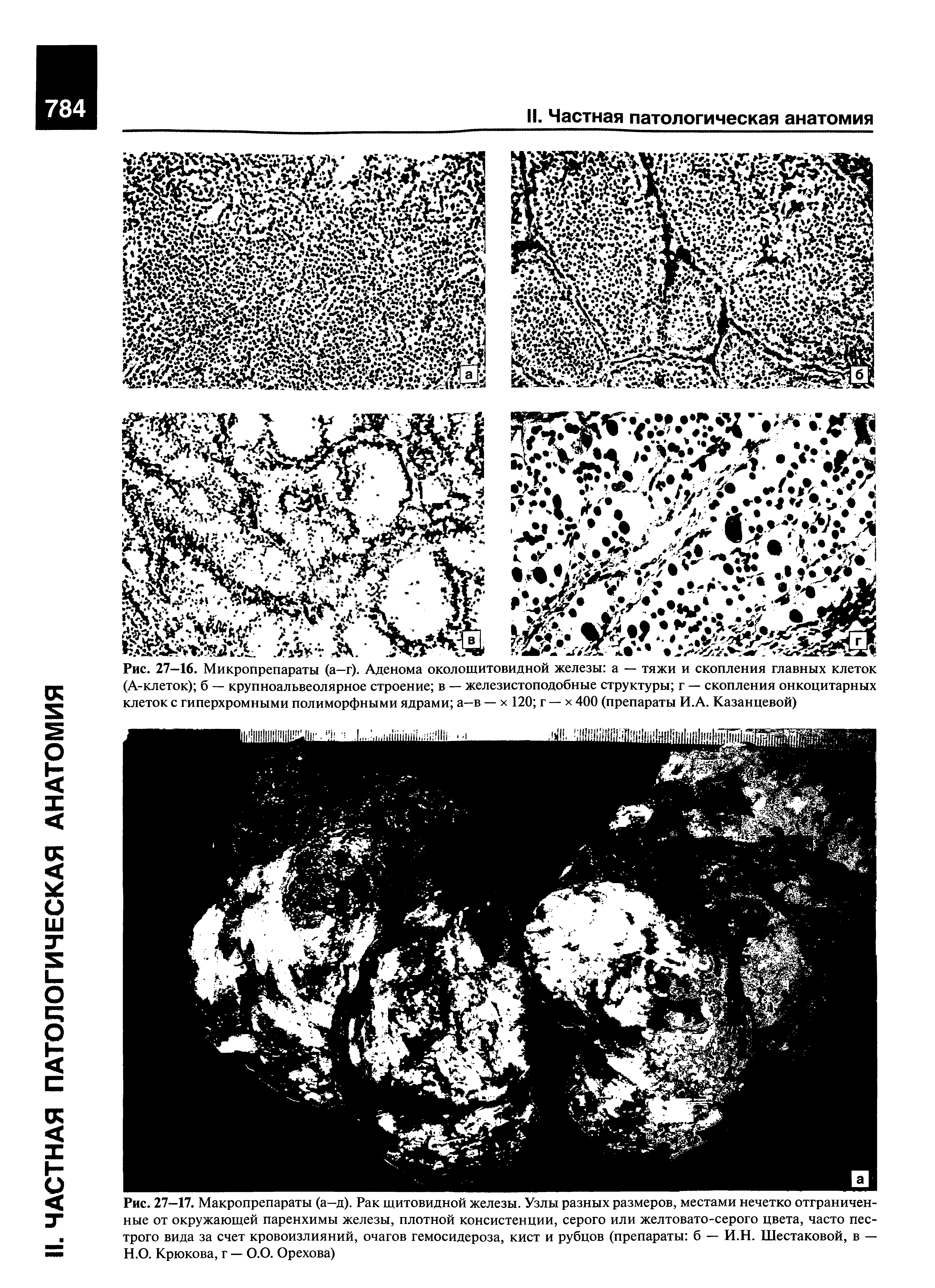 Рис. 27-16. Микропрепараты (а-г). Аденома околощитовидной железы а — тяжи и скопления главных клеток (А-клеток) б — крупноальвеолярное строение в — железистоподобные структуры г — скопления онкоцитарных клеток с гиперхромными полиморфными ядрами а—в — х 120 г — х 400 (препараты И.А. Казанцевой)...