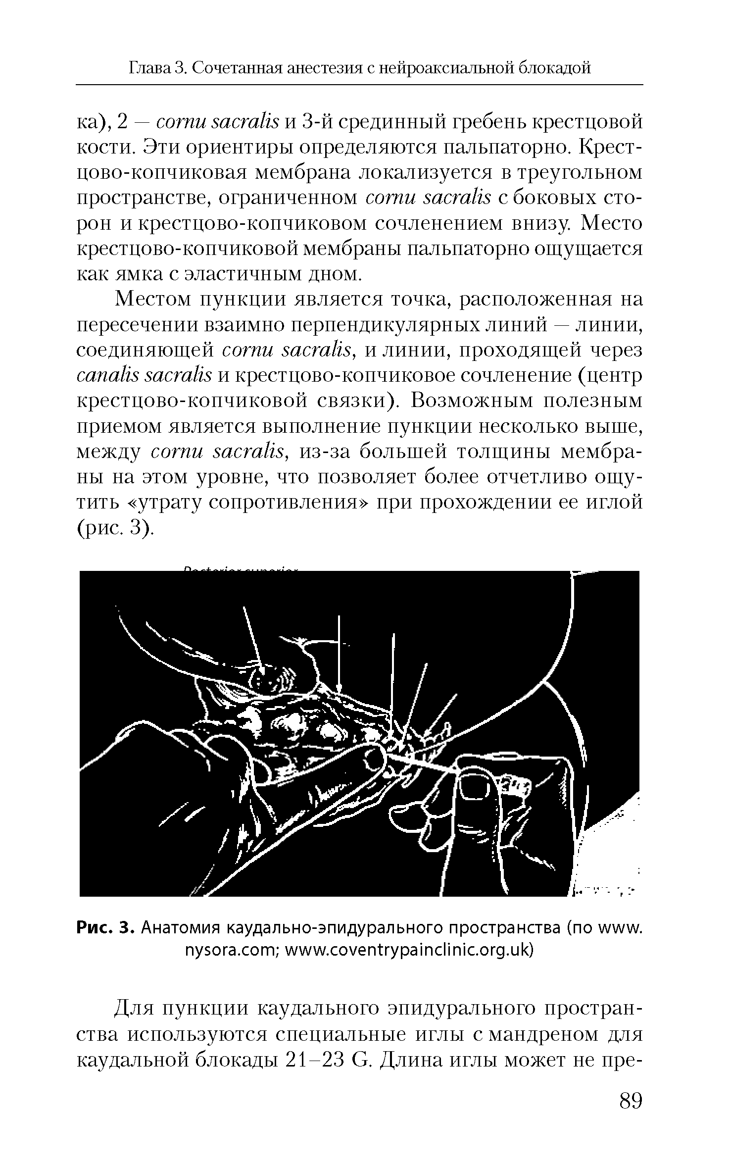 Рис. 3. Анатомия каудально-эпидурального пространства (по . . . . . )...