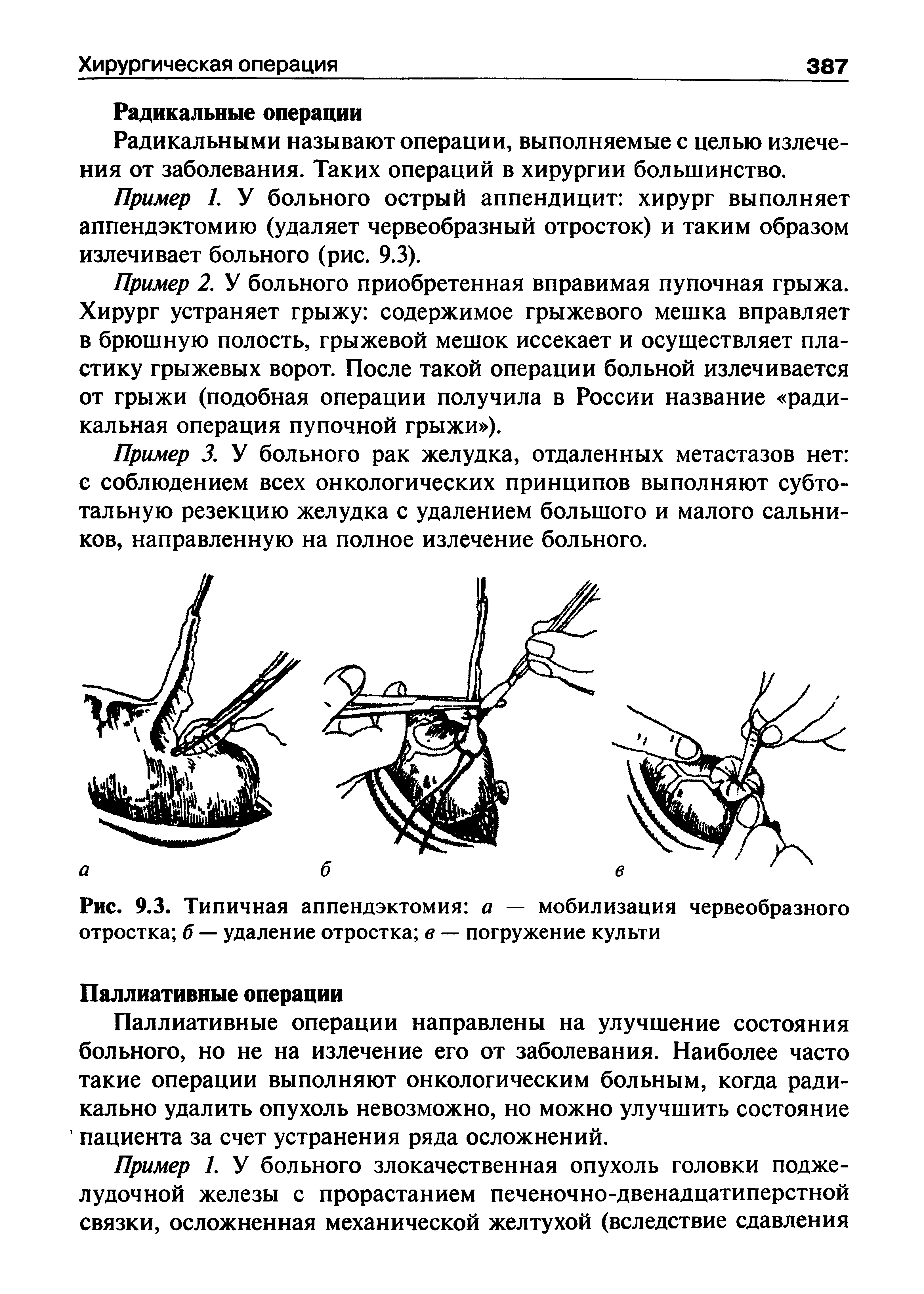 Рис. 9.3. Типичная аппендэктомия а — мобилизация червеобразного отростка б — удаление отростка в — погружение культи...