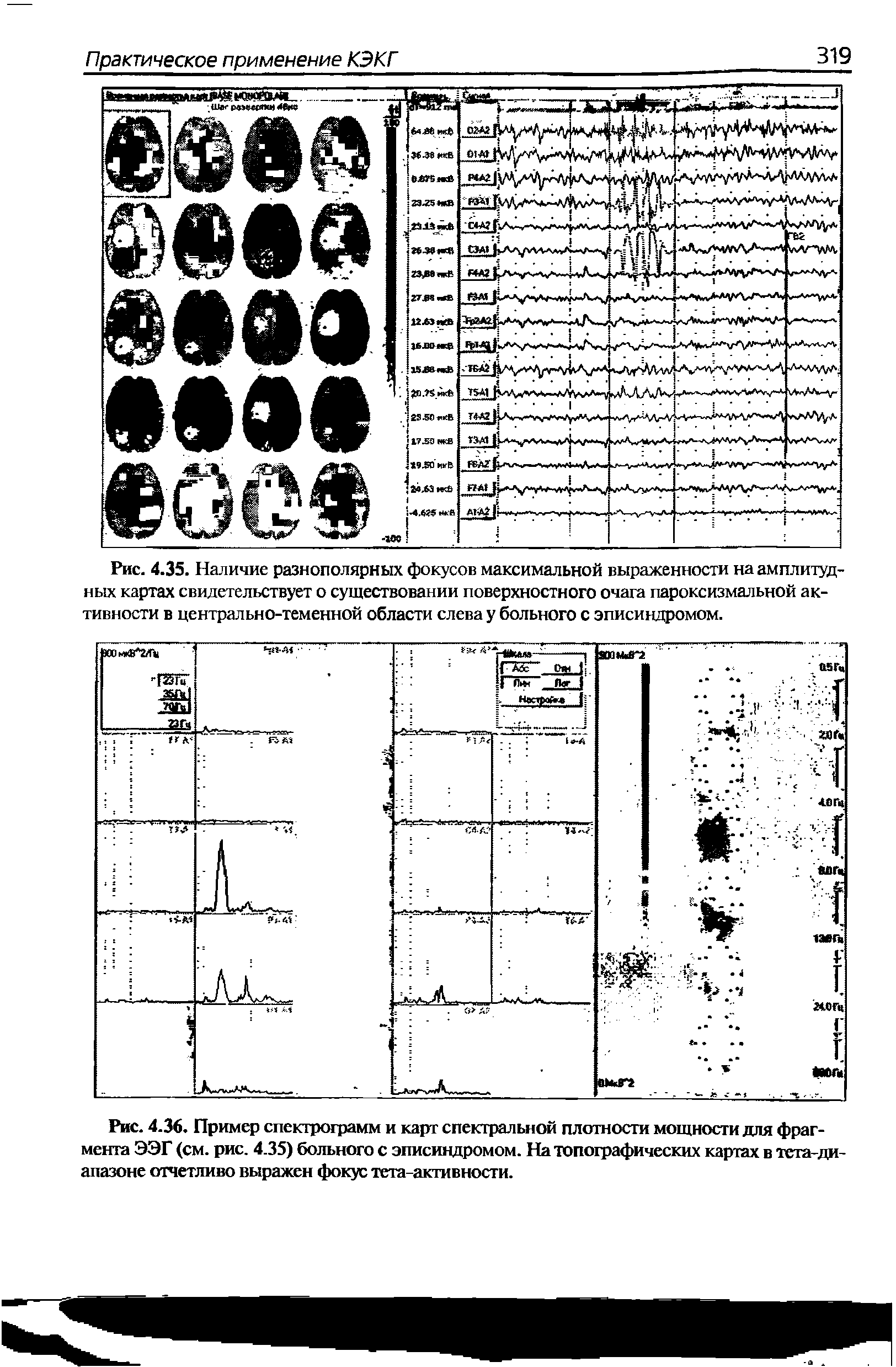 Рис. 4.36. Пример спектрограмм и карт спектральной плотности мощности для фрагмента ЭЭГ (см. рис. 4.35) больного с эписиндромом. На топографических каргах в тета-ди-апазоне отчетливо выражен фокус тета-активности.