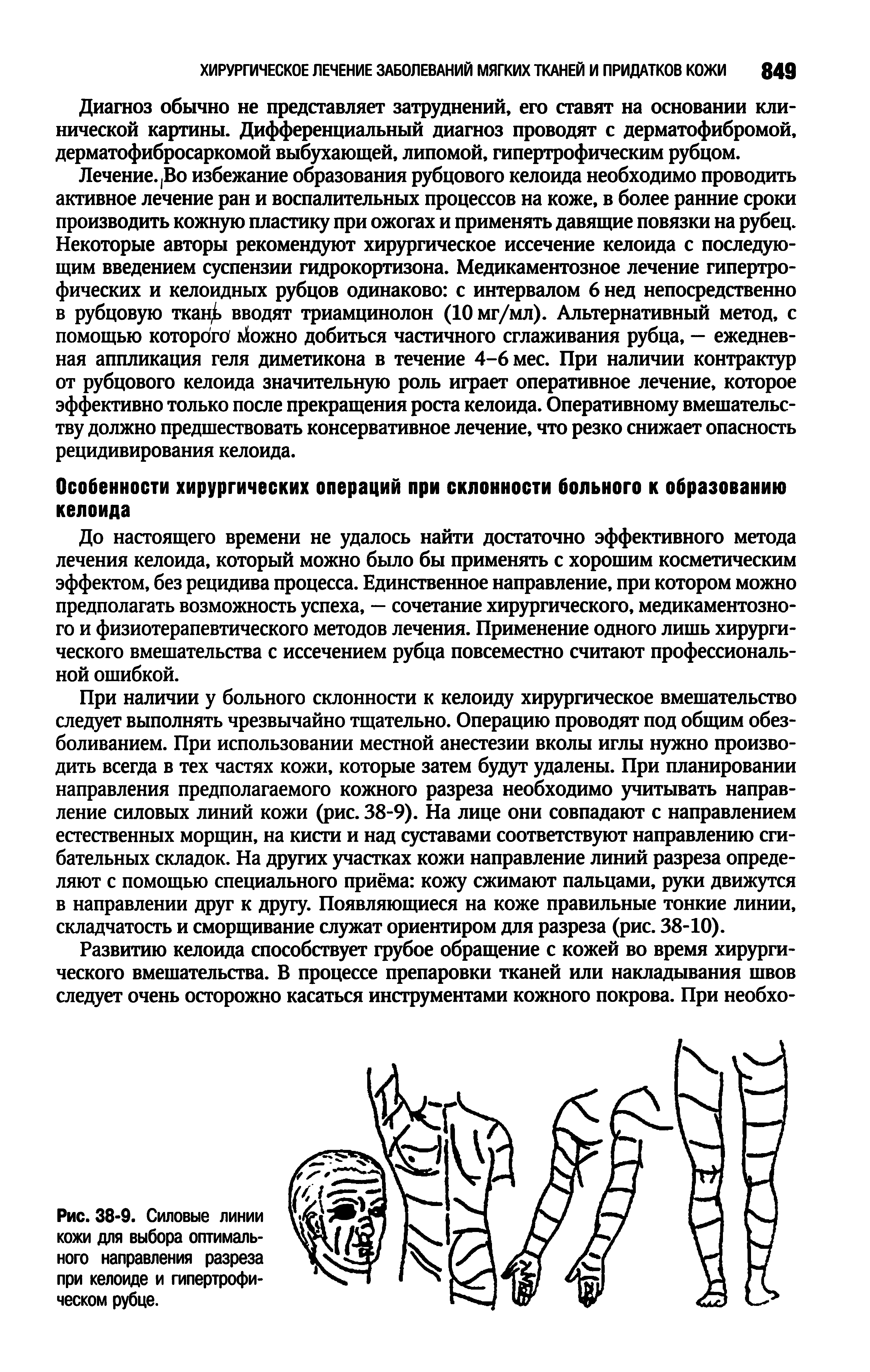 Рис. 38-9. Силовые линии кожи для выбора оптимального направления разреза при келоиде и гипертрофическом рубце.