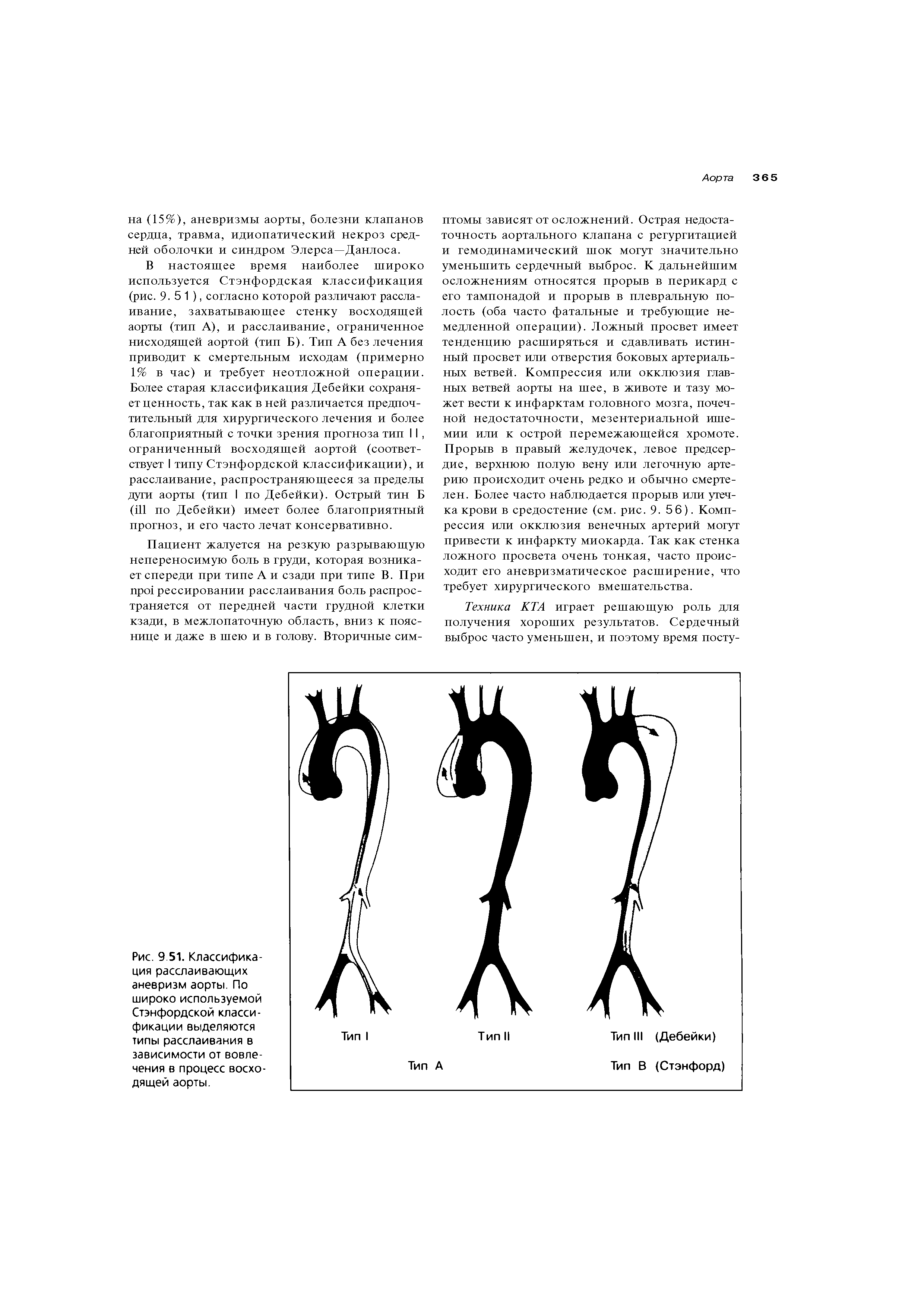 Рис. 9 51. Классификация расслаивающих аневризм аорты. По широко используемой Стэнфордской классификации выделяются типы расслаивания в зависимости от вовлечения в процесс восходящей аорты.