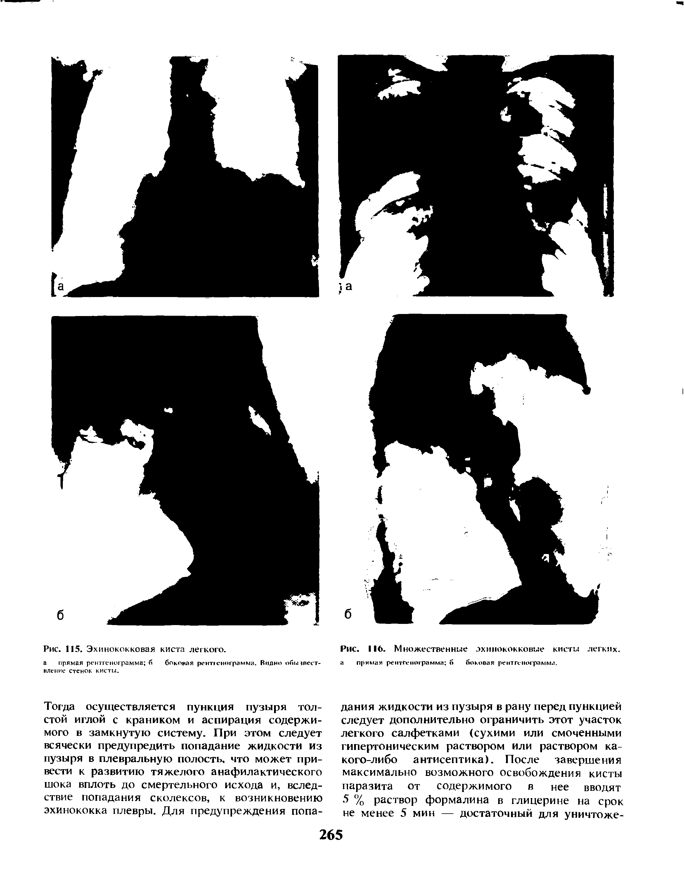 Рис. 116. Множественные эхинококковые кисты легких, а прямая рентгенограмма б боковая рентгенограмма.