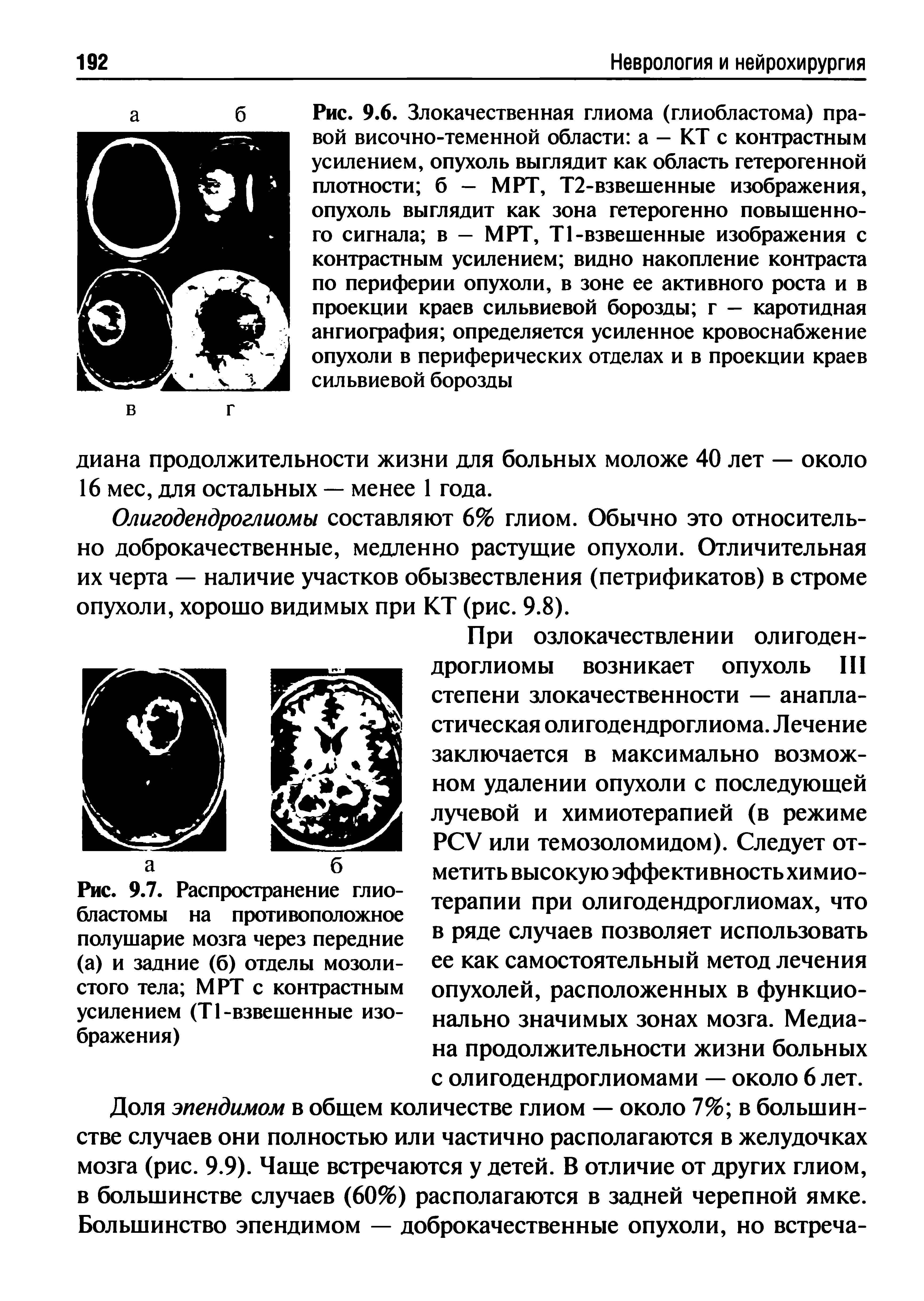 Рис. 9.7. Распространение глиобластомы на противоположное полушарие мозга через передние (а) и задние (б) отделы мозолистого тела МРТ с контрастным усилением (Т1-взвешенные изображения)...