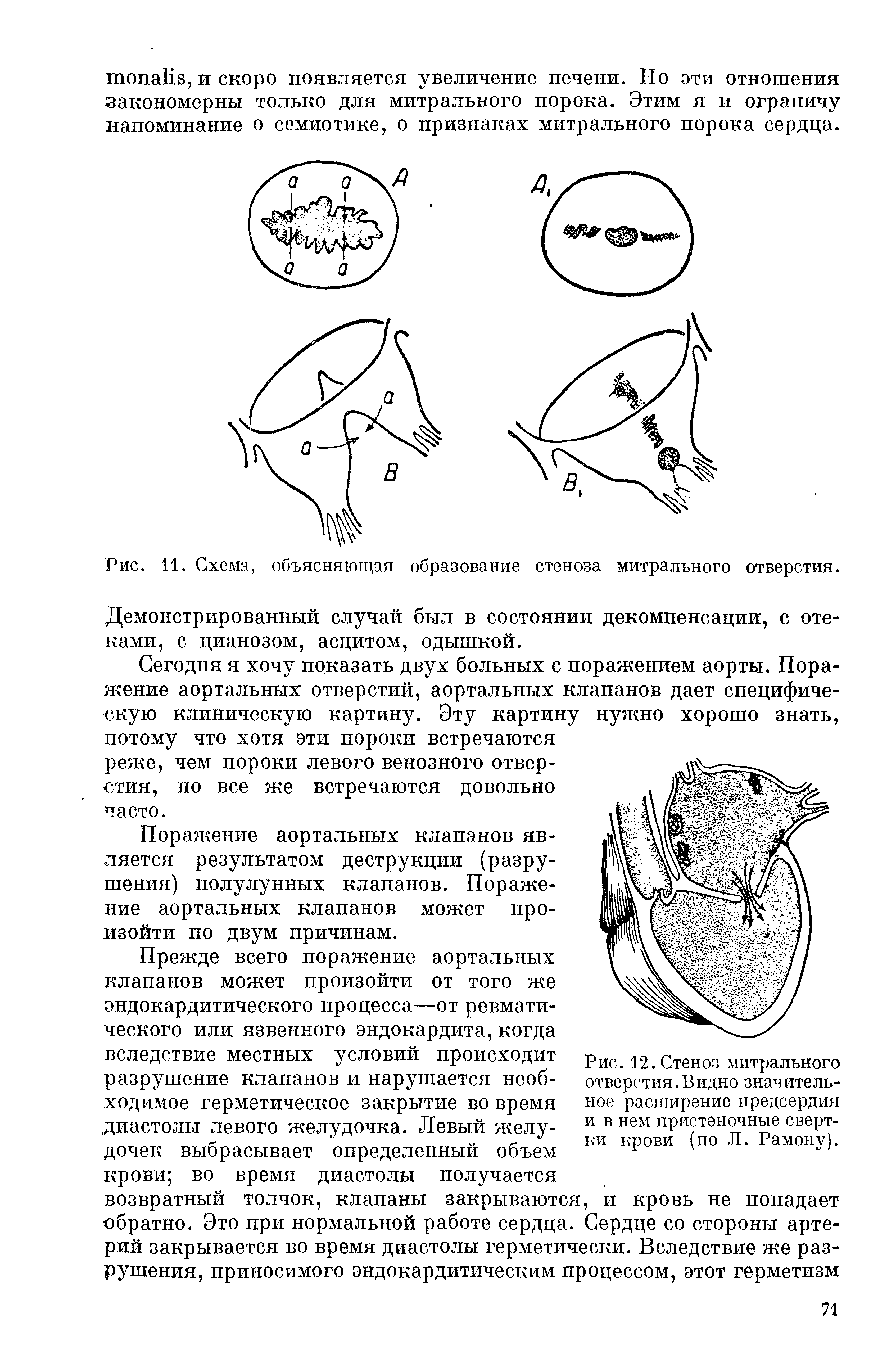 Рис. 11. Схема, объясняющая образование стеноза митрального отверстия.