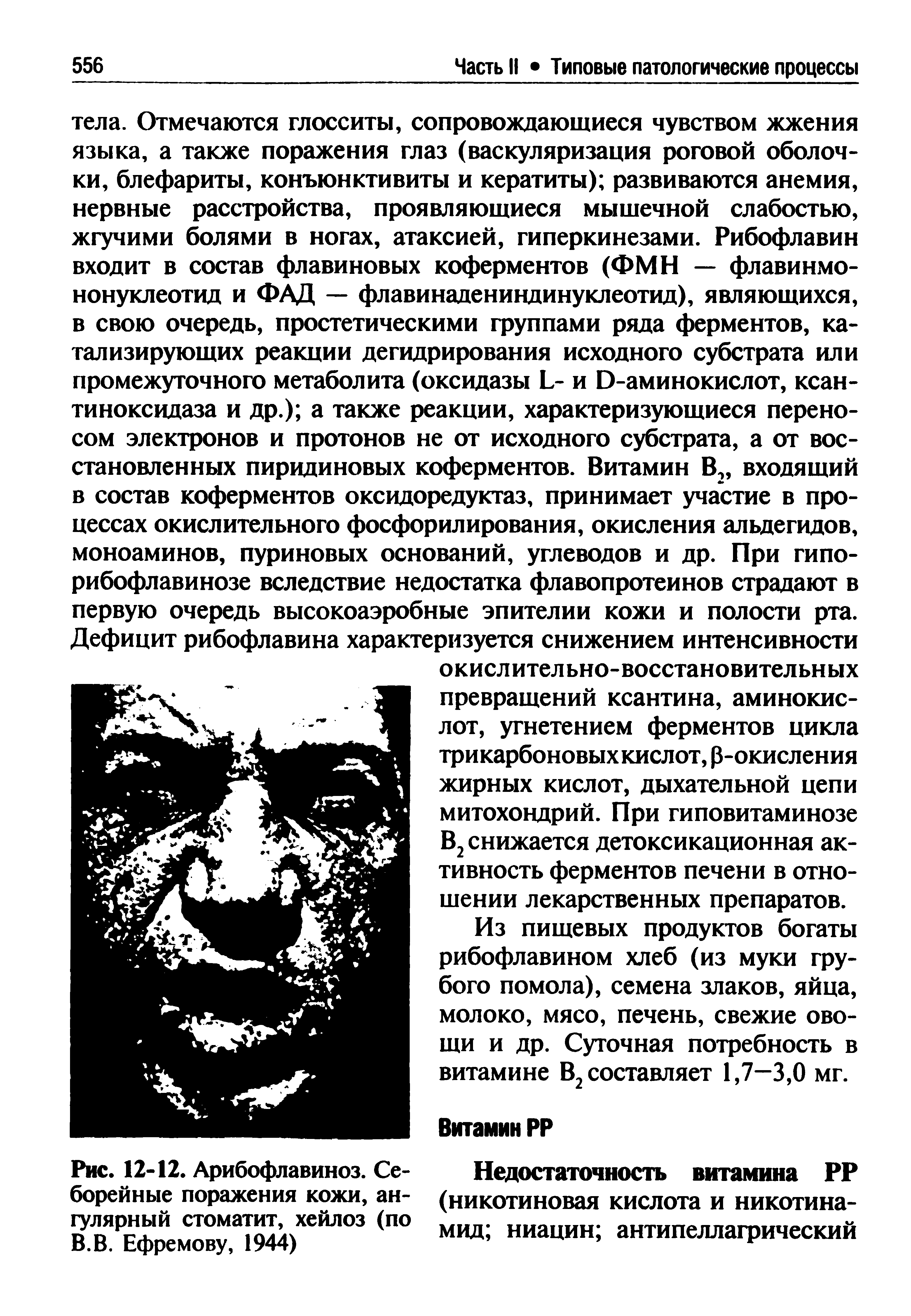 Рис. 12-12. Арибофлавиноз. Себорейные поражения кожи, ан-гулярный стоматит, хейлоз (по В.В. Ефремову, 1944)...