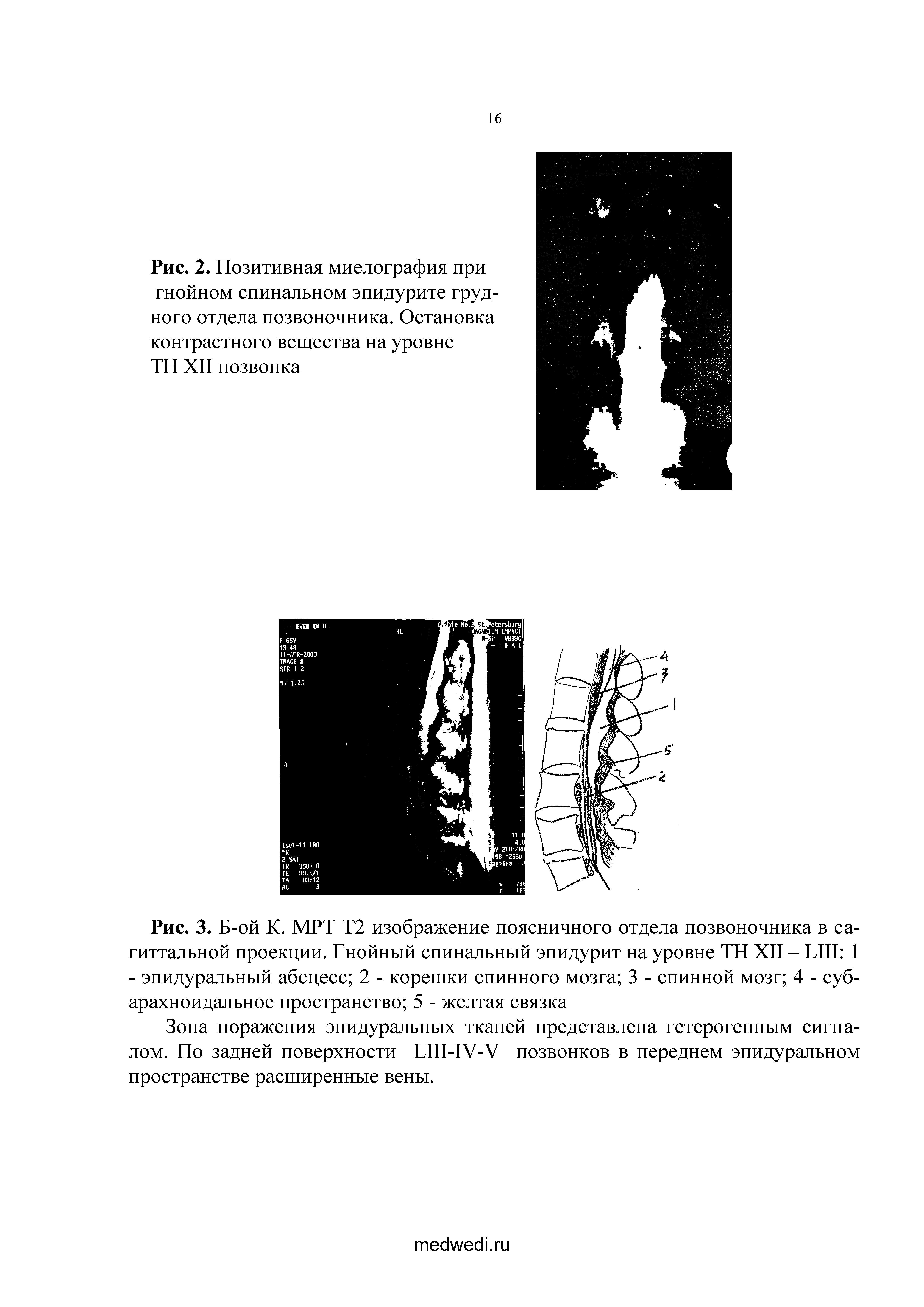 Рис. 3. Б-ой К. МРТ Т2 изображение поясничного отдела позвоночника в сагиттальной проекции. Гнойный спинальный эпидурит на уровне TH XII - LUI 1 - эпидуральный абсцесс 2 - корешки спинного мозга 3 - спинной мозг 4 - субарахноидальное пространство 5 - желтая связка...