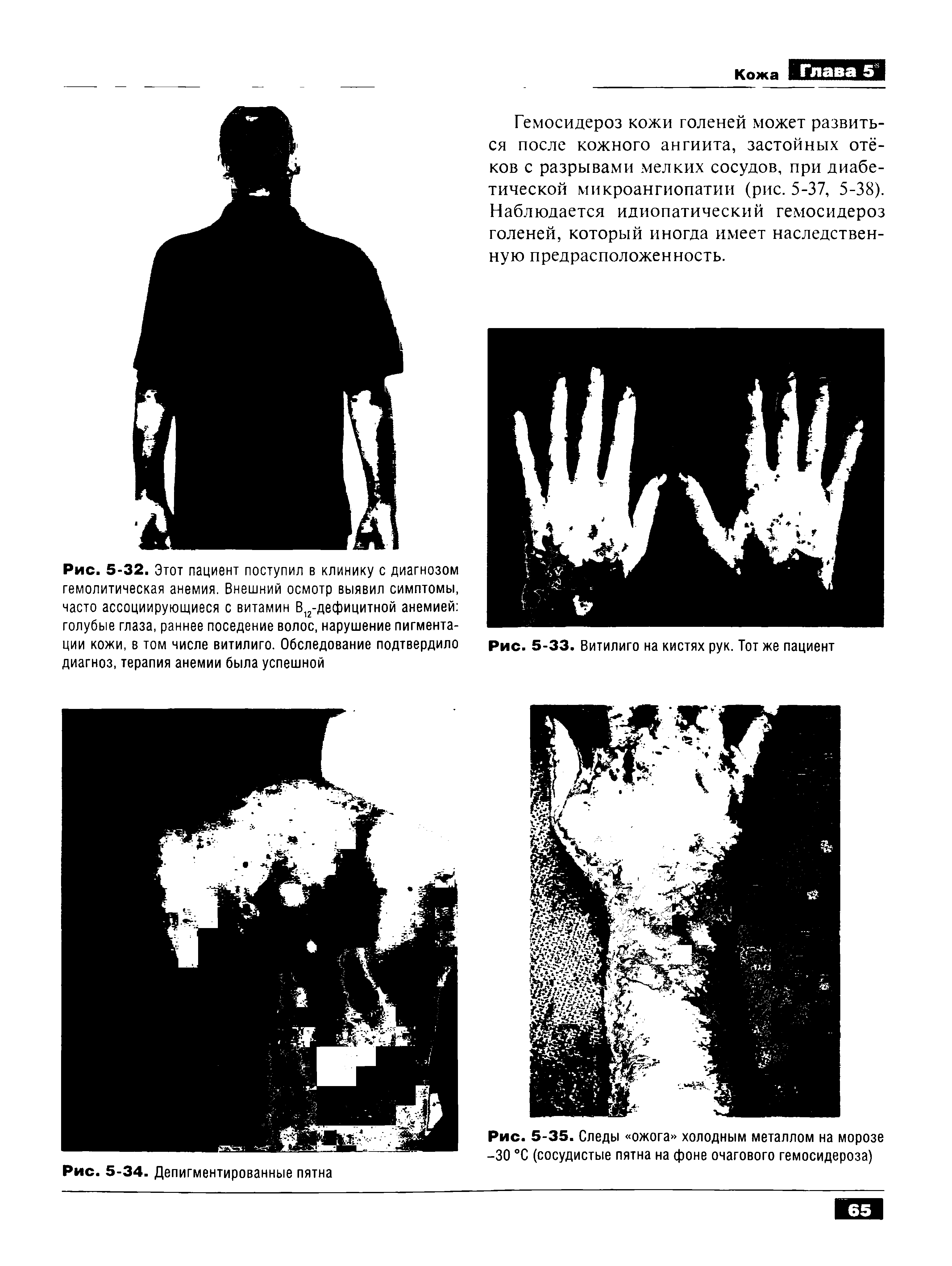 Рис. 5-32. Этот пациент поступил в клинику с диагнозом гемолитическая анемия. Внешний осмотр выявил симптомы, часто ассоциирующиеся с витамин В12-дефицитной анемией голубые глаза, раннее поседение волос, нарушение пигментации кожи, в том числе витилиго. Обследование подтвердило диагноз, терапия анемии была успешной...