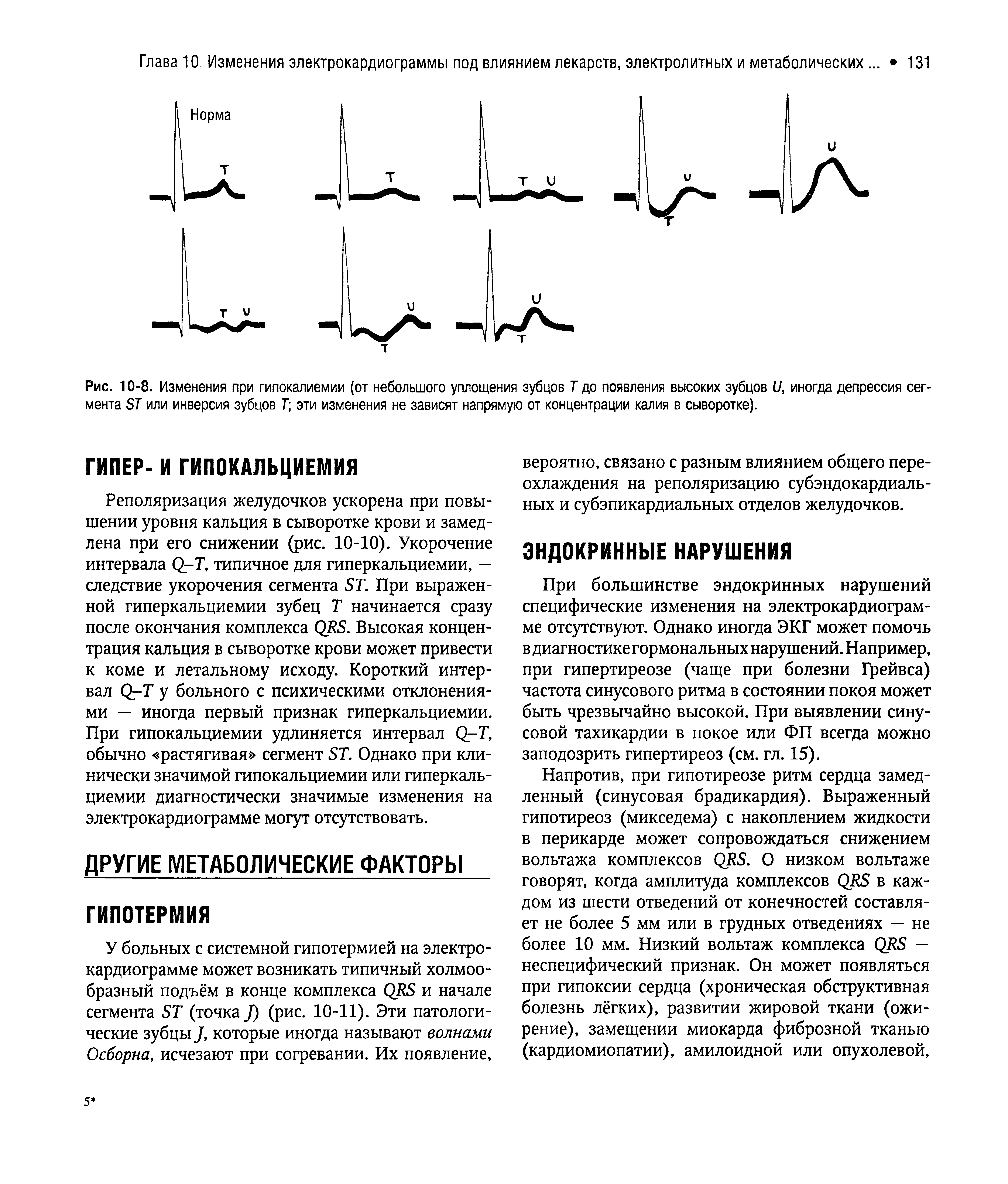 Рис. 10-8. Изменения при гипокалиемии (от небольшого уплощения зубцов Т до появления высоких зубцов I/, иногда депрессия сегмента БТ или инверсия зубцов Г эти изменения не зависят напрямую от концентрации калия в сыворотке).