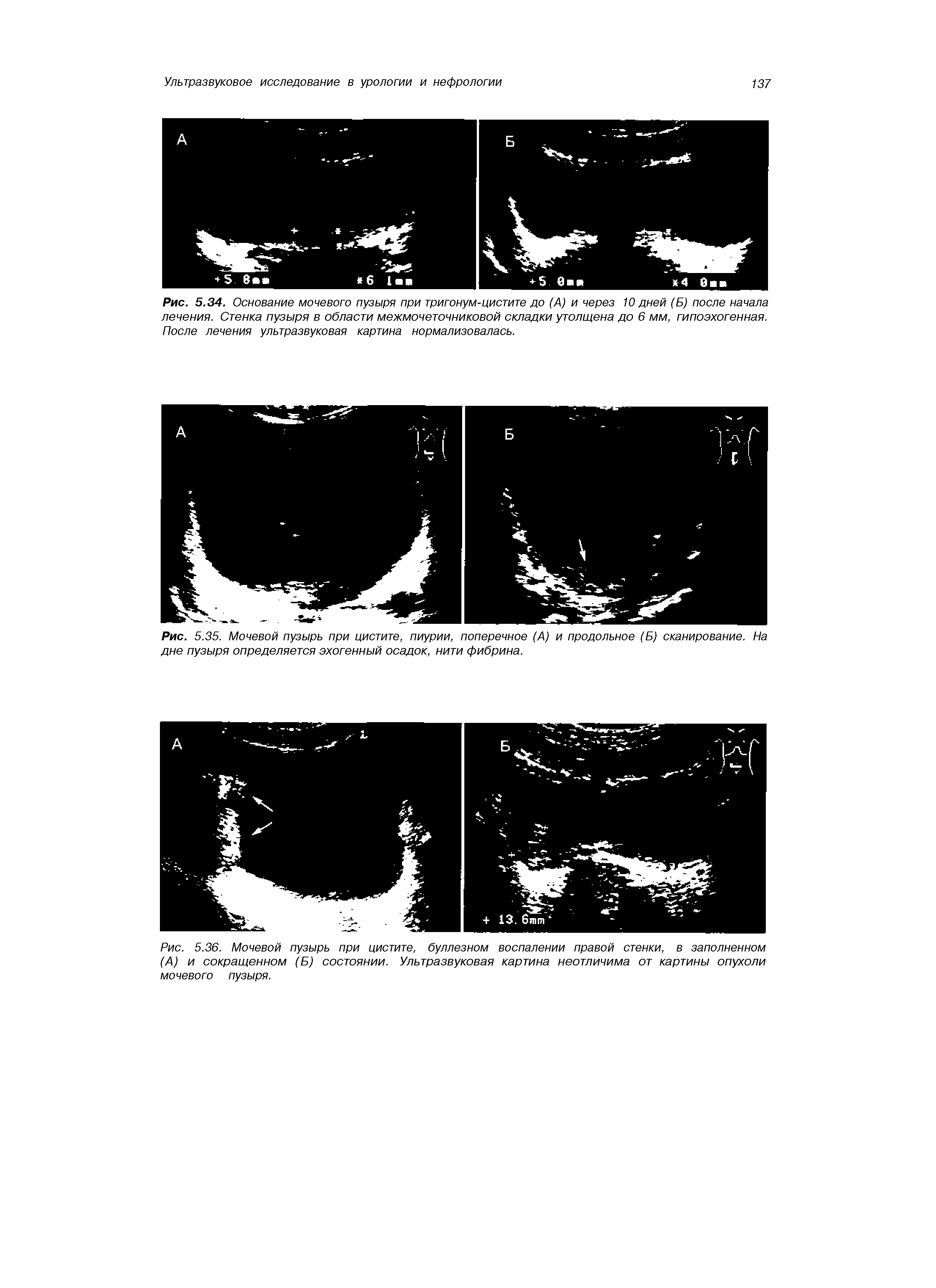 Рис. 5.36. Мочевой пузырь при цистите, буллезном воспалении правой стенки, в заполненном (А) и сокращенном (Б) состоянии. Ультразвуковая картина неотличима от картины опухоли мочевого пузыря.