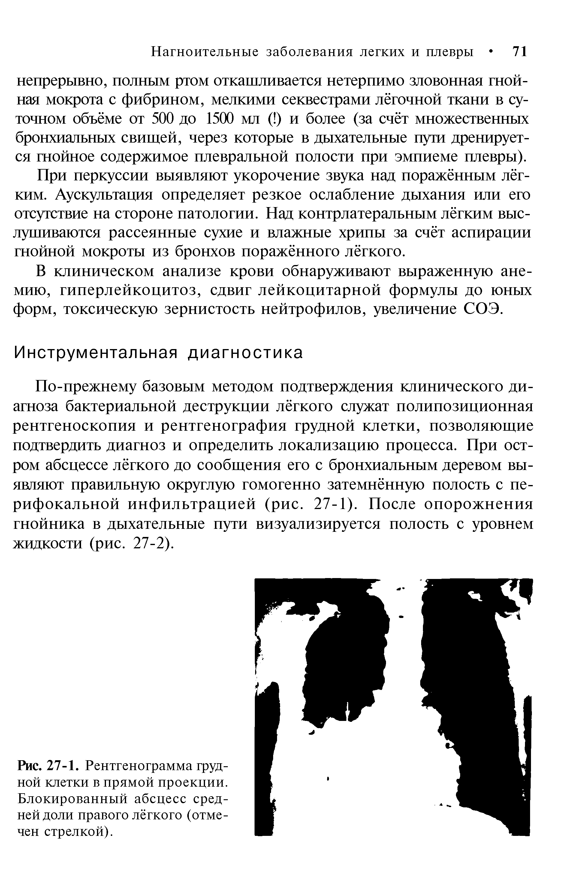 Рис. 27-1. Рентгенограмма грудной клетки в прямой проекции. Блокированный абсцесс средней доли правого лёгкого (отмечен стрелкой).