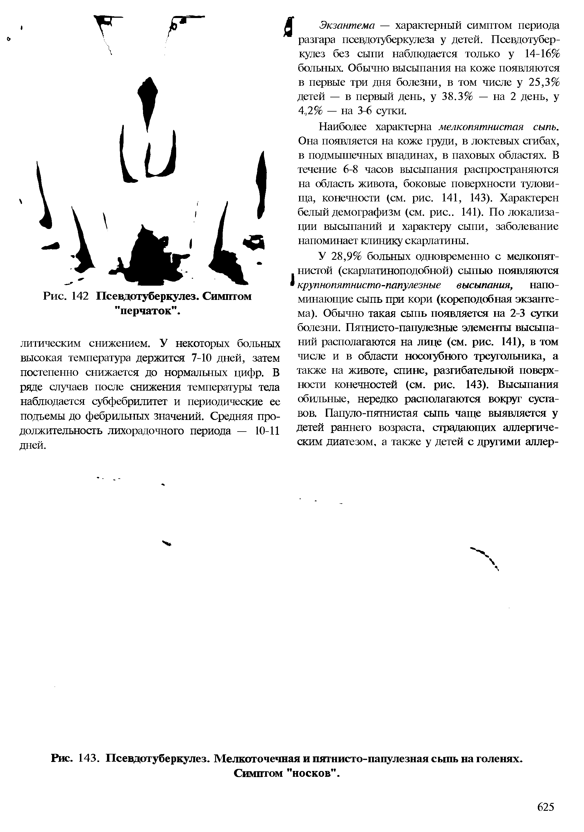 Рис. 143. Псевдотуберкулез. Мелкоточечная и пятнисто-папулезная сыпь на голенях. Симптом "носков".