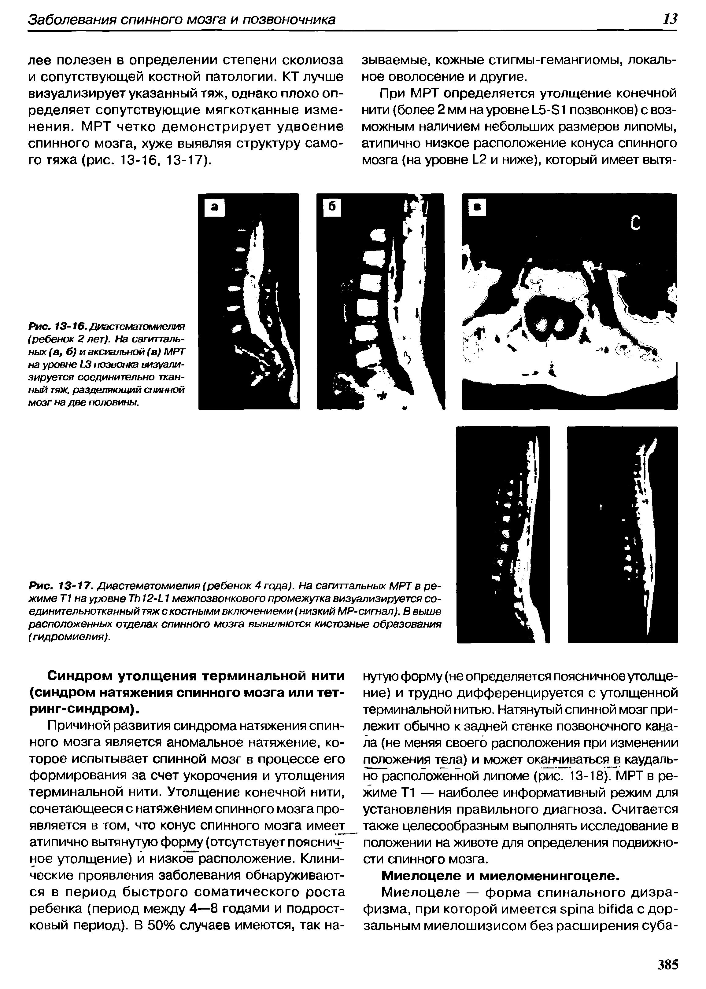 Рис. 13-16. Диастематомиелия (ребенок 2 лет). На сагиттальных (а, б) и аксиальной (в) МРТ на уровне L3 позвонка визуализируется соединительно тканный тяж, разделяющий спинной мозг на две половины.