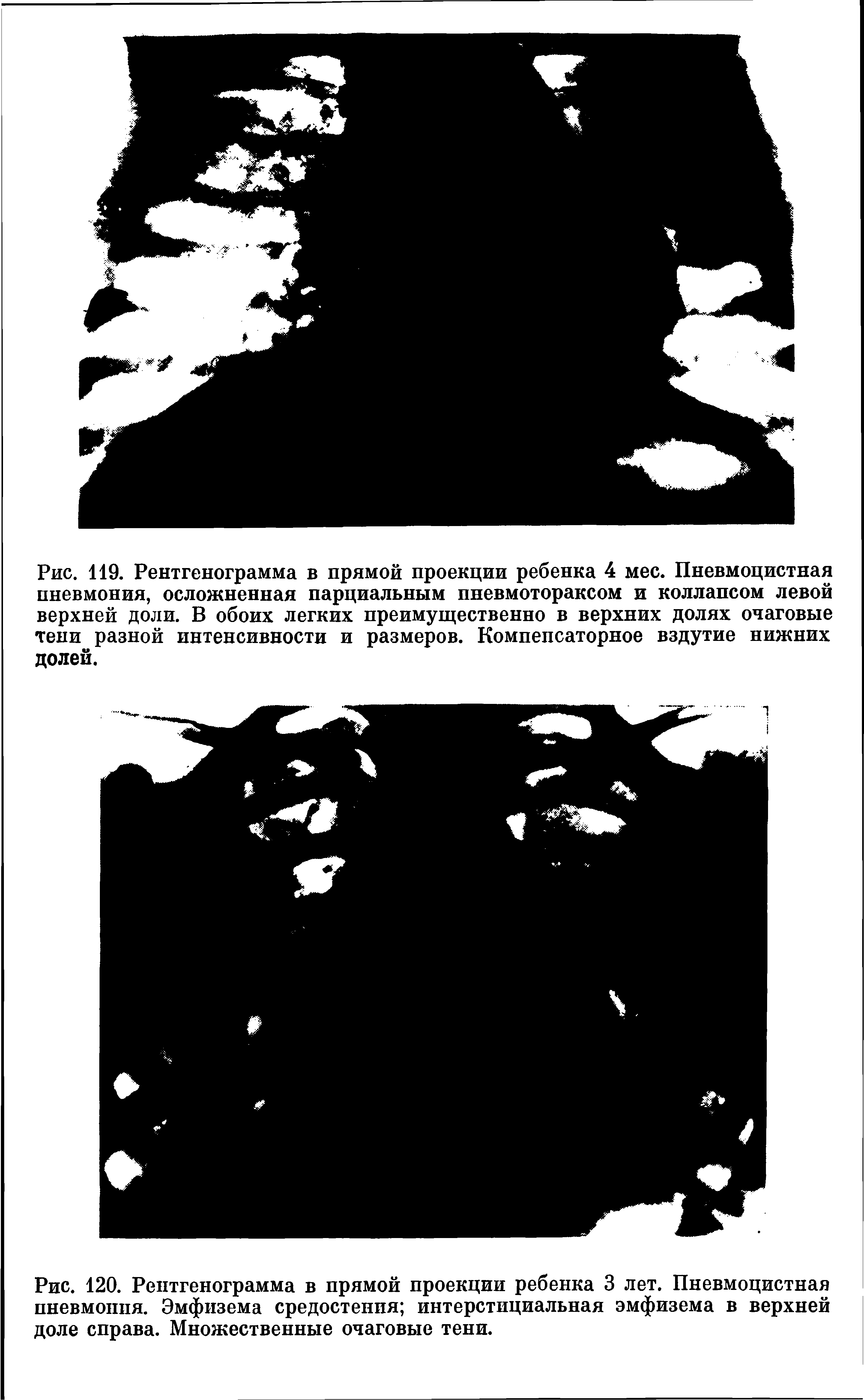 Рис. 120. Рентгенограмма в прямой проекции ребенка 3 лет. Пневмоцистная пневмония. Эмфизема средостения интерстициальная эмфизема в верхней доле справа. Множественные очаговые тени.