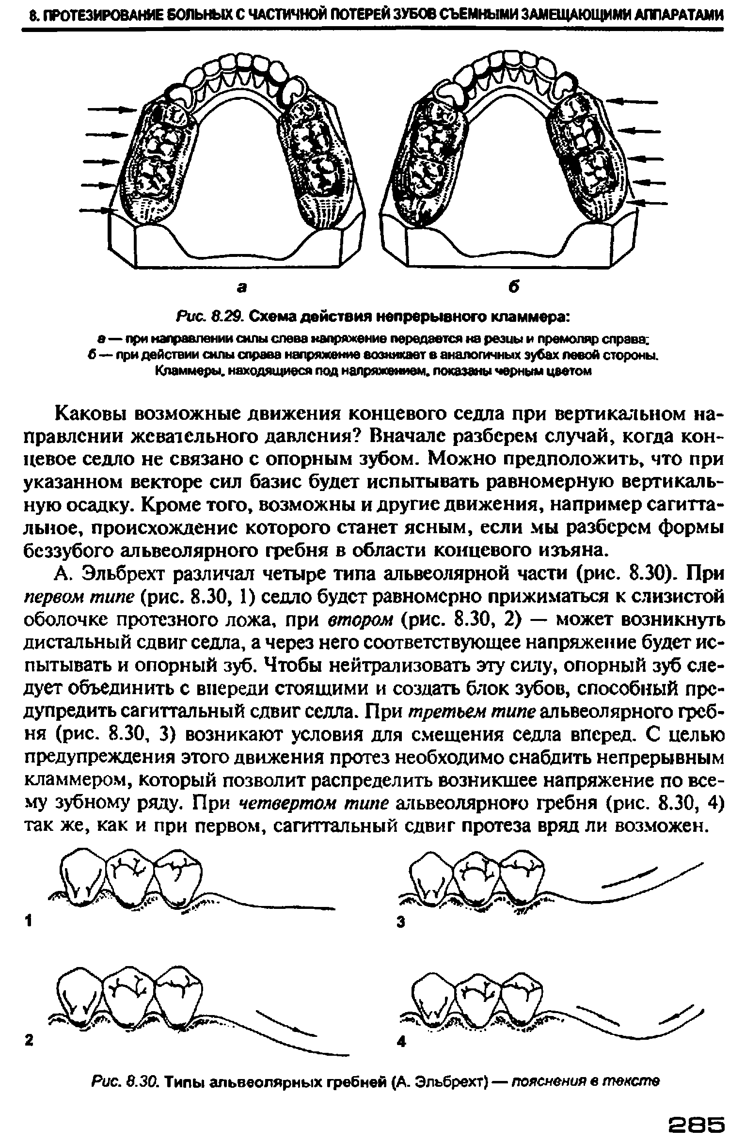 Рис. 8.30. Типы альвеолярных гребней (А. Эльбрехт) — пояснения в тексте...