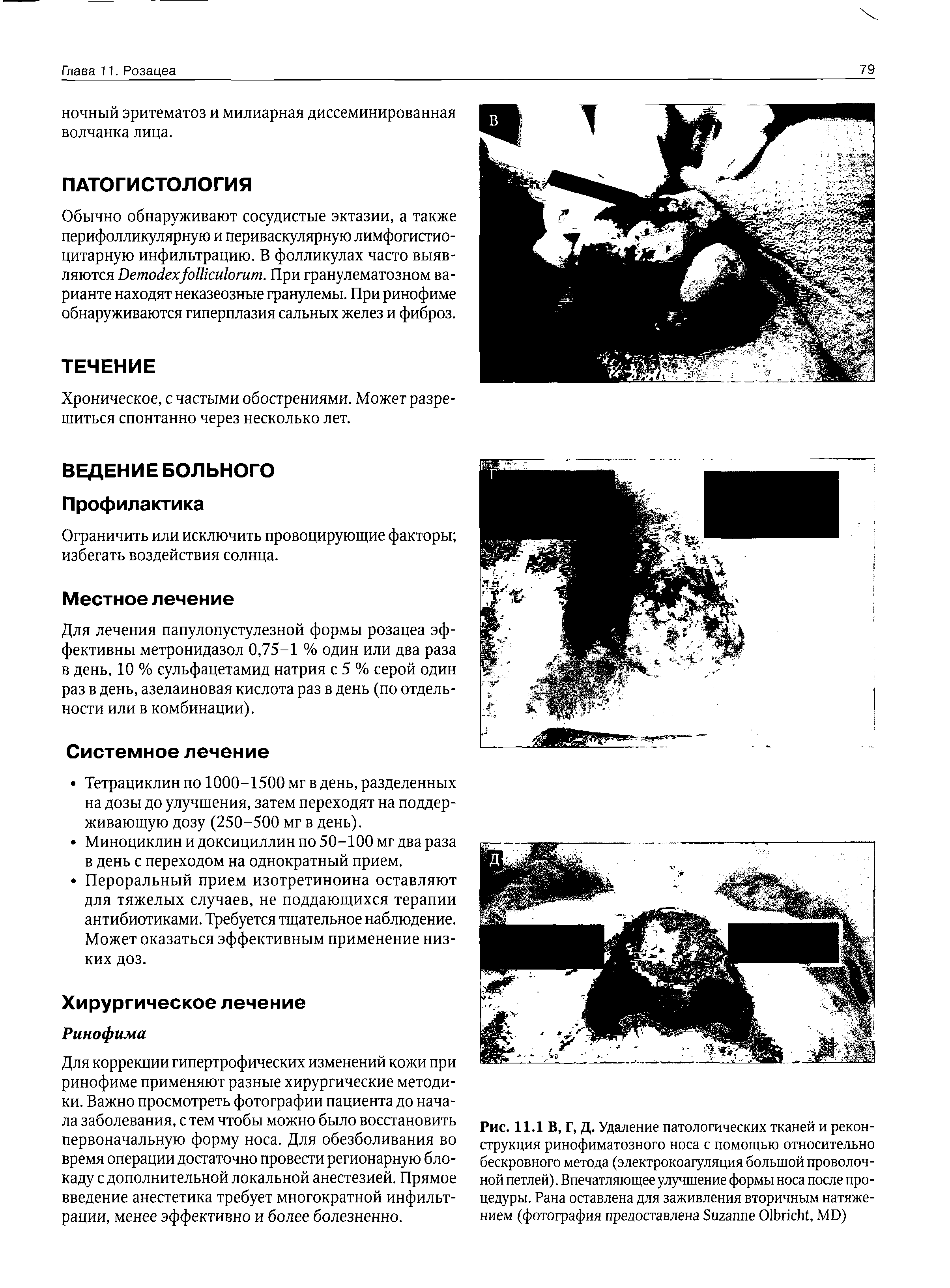 Рис. 11.1 В, Г, Д. Удаление патологических тканей и реконструкция ринофиматозного носа с помощью относительно бескровного метода (электрокоагуляция большой проволочной петлей). Впечатляющее улучшение формы носа после процедуры. Рана оставлена для заживления вторичным натяжением (фотография предоставлена S O , MD)...
