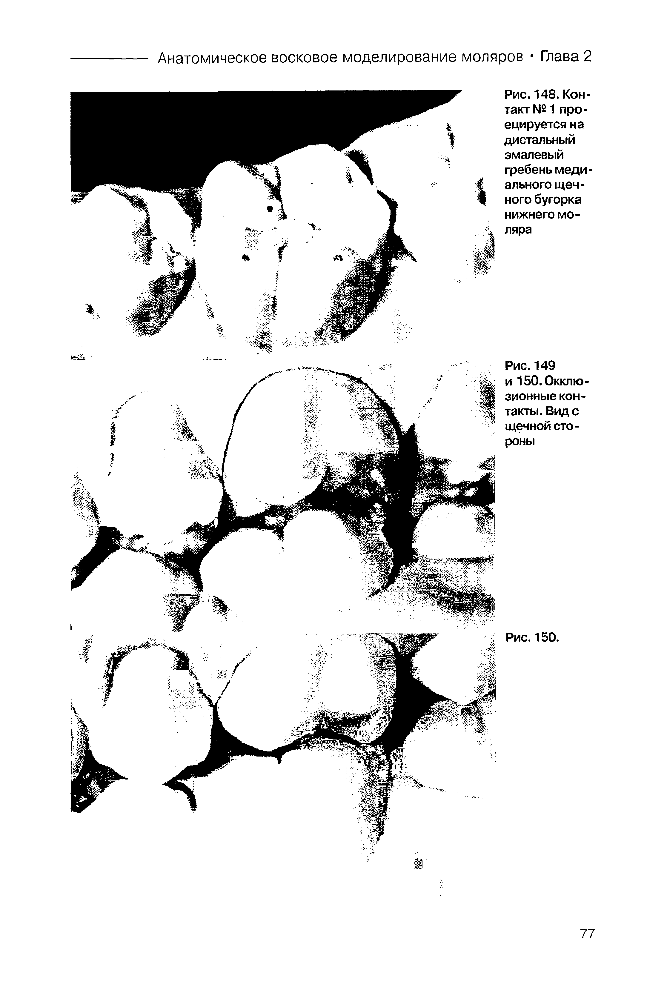 Рис.148. Контакт № 1 проецируется на дистальный эмалевый гребень медиального щечного бугорка нижнего моляра...