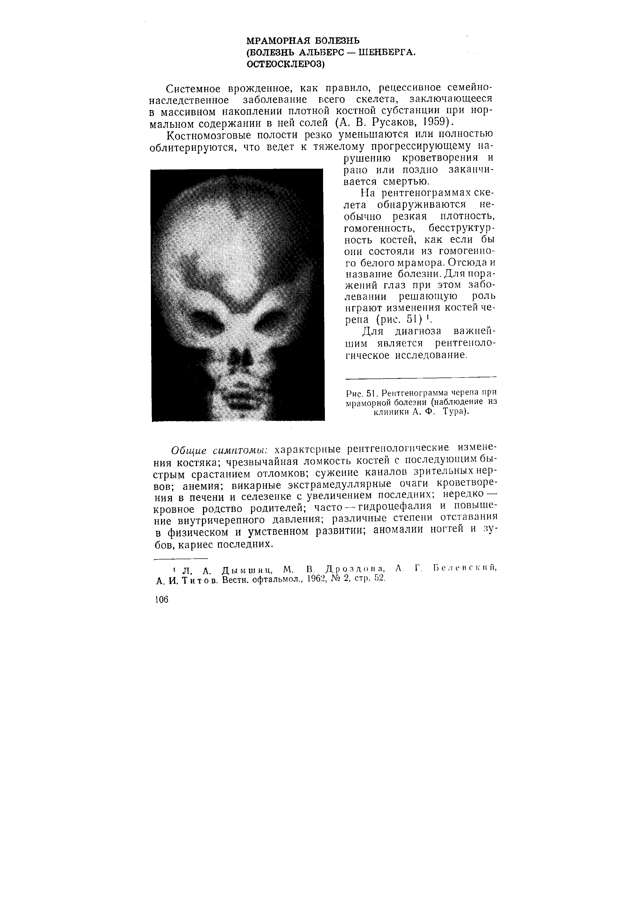 Рис. 51. Рентгенограмма черепа при мраморной болезни (наблюдение из клиники А. Ф. Тура).