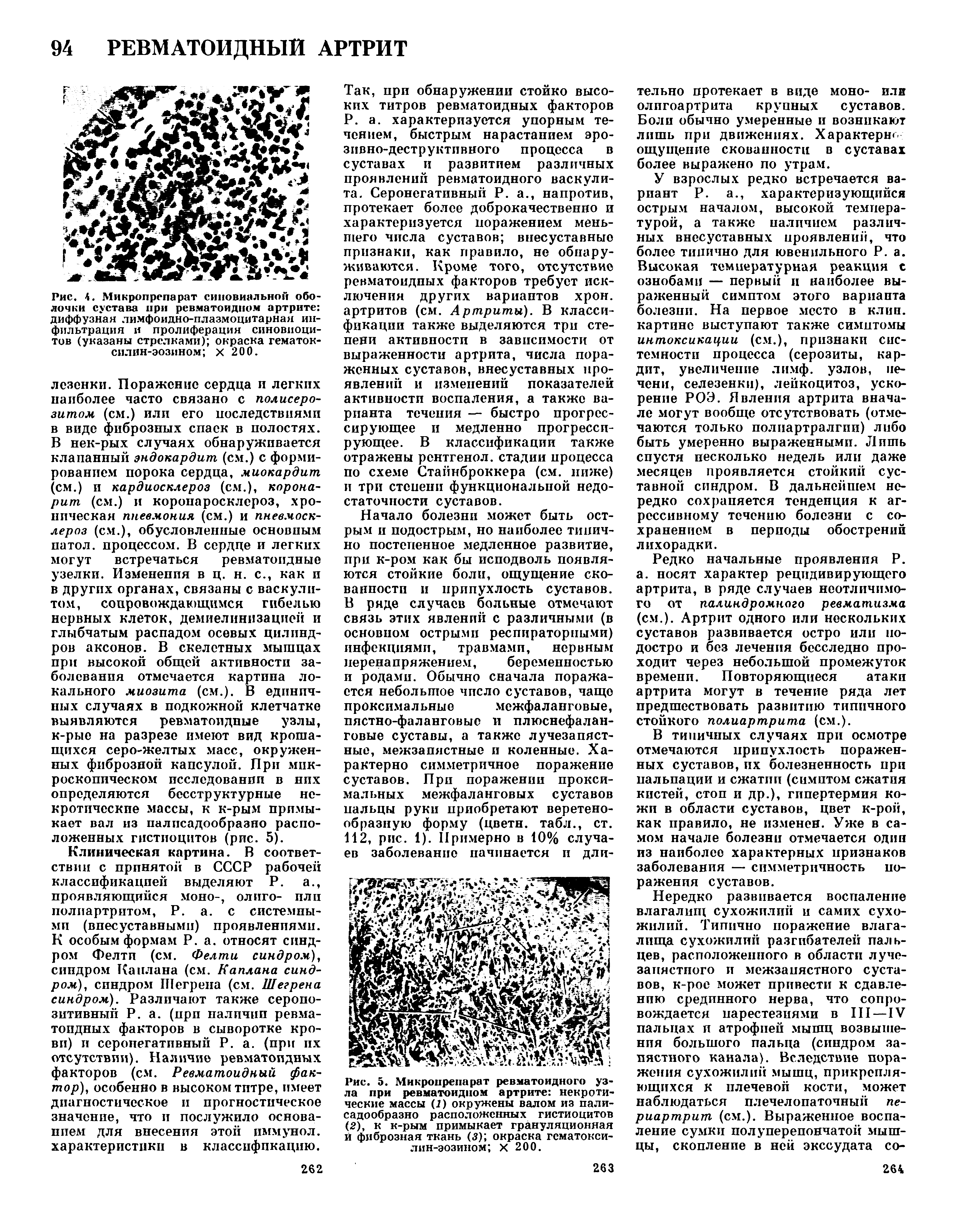 Рис. 4. Микропрепарат синовиально оболочки сустава при ревматоидном артрите диффузная лимфоидно-плазмоцитарная инфильтрация и пролиферация синовиоцитов (указаны стрелками) окраска гематок-силин-эозином х 200.