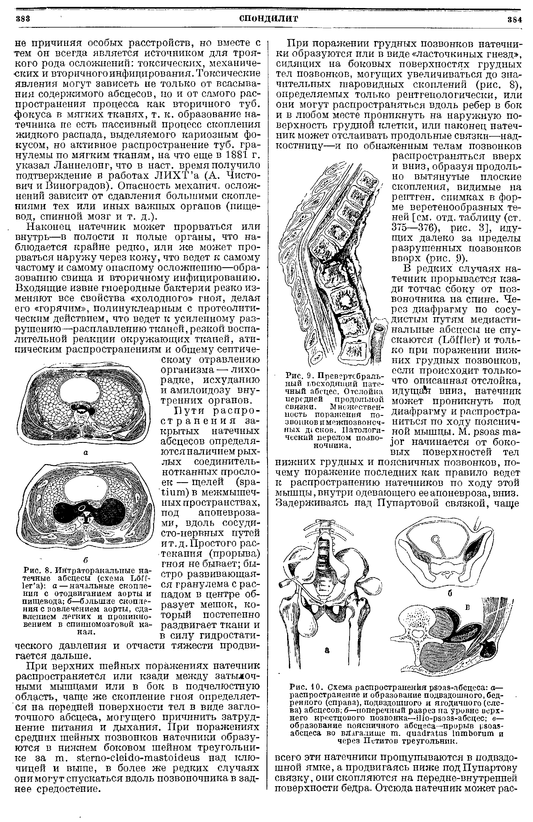 Рис. 10. Схема распространения рвоаз-абсцеса а— распространение и образование подвздошного, бедренного (справа), подвздошного и ягодичного (слева) абсцесов б—поперечный разрез па уровне верхнего крестцового позвонка— о-раоаз-абсцес а— образование поясничного абсцеса—прорыв рзоа -абсцеса во влагалище т. диайгаЩэ ШтЪогит и через Петитов треугольник.