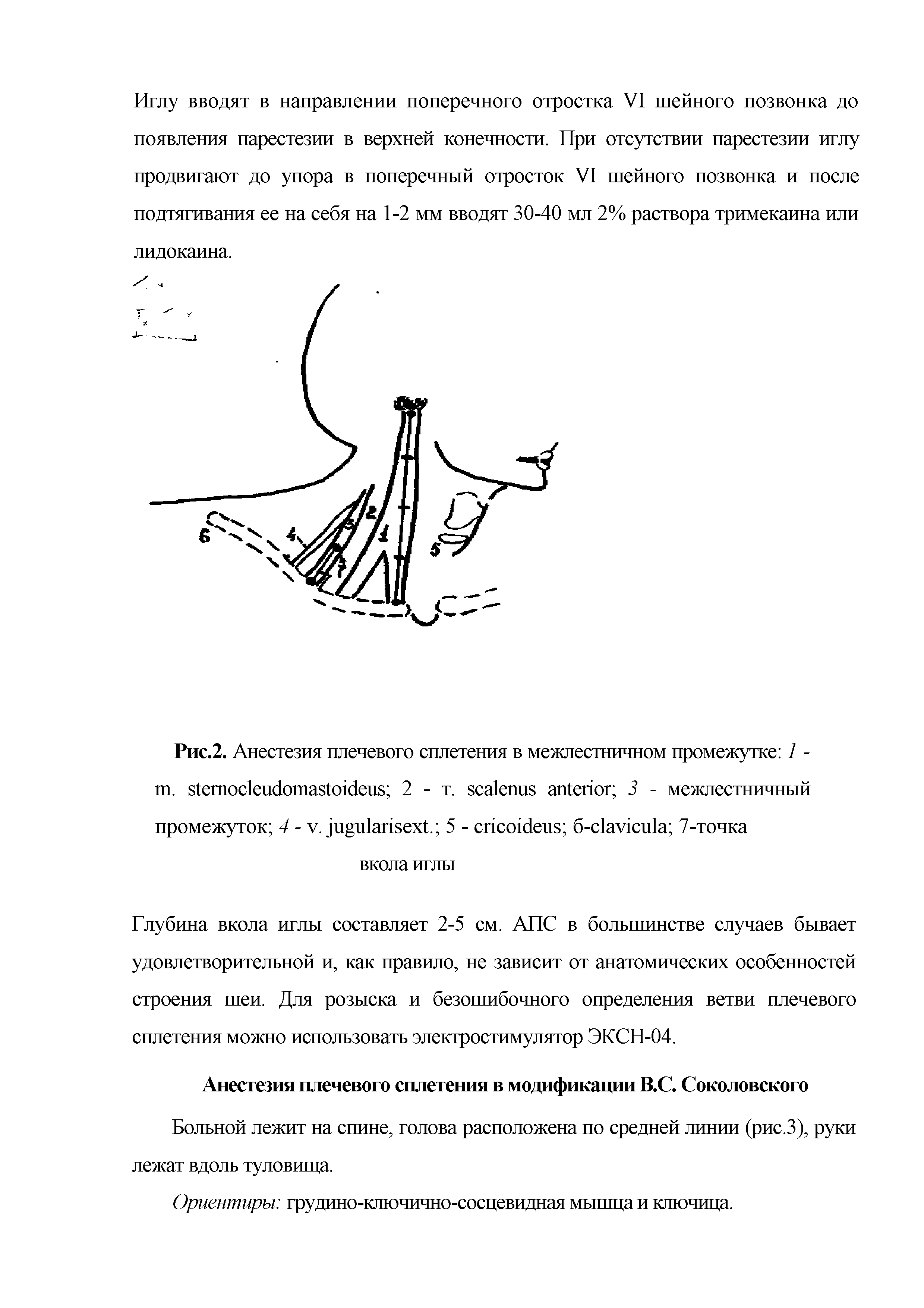 Рис.2. Анестезия плечевого сплетения в межлестничном промежутке 1 -ш. 2 - т. 3 - межлестничный промежуток 4 - . . 5 - б- 7-точка...